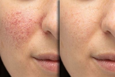 Split-face close-up showing red facial blemishes on one side and clear skin on the other
