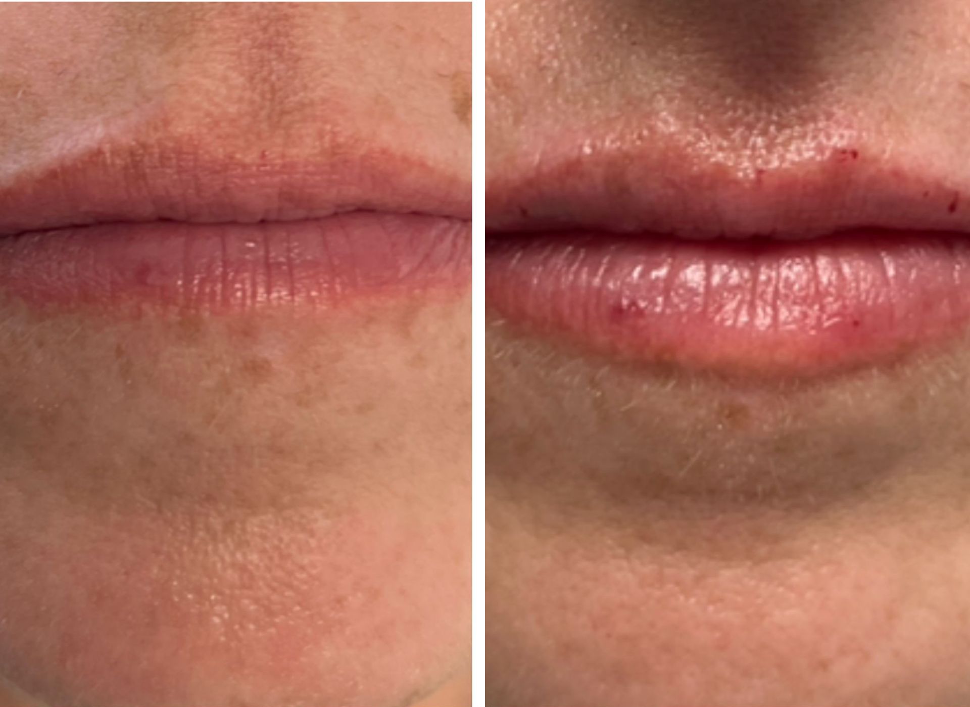 Two photos: lips before and after a procedure, showing redness and swelling.