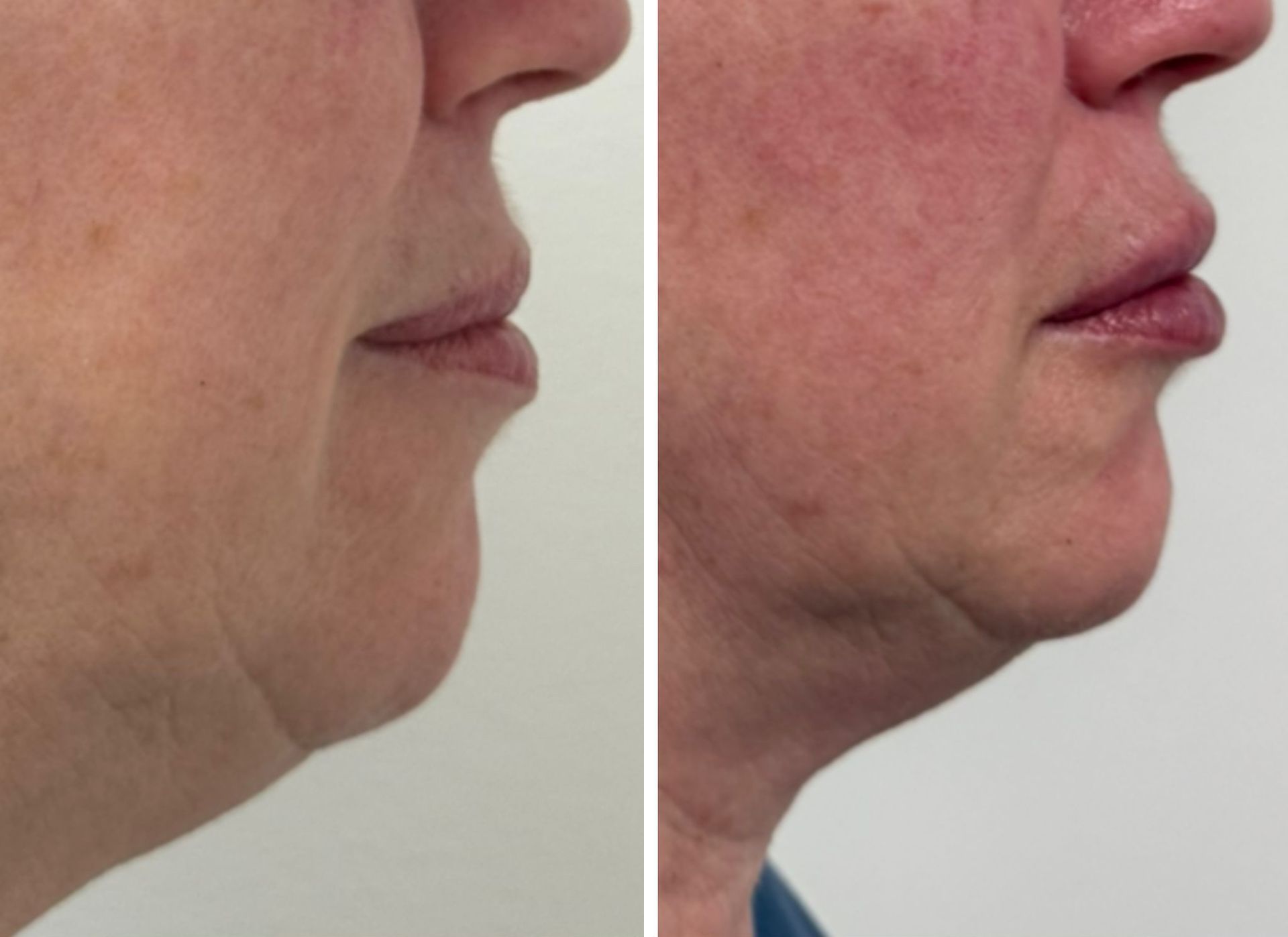 Before and after chin and lip filler; skin is lighter and more defined.