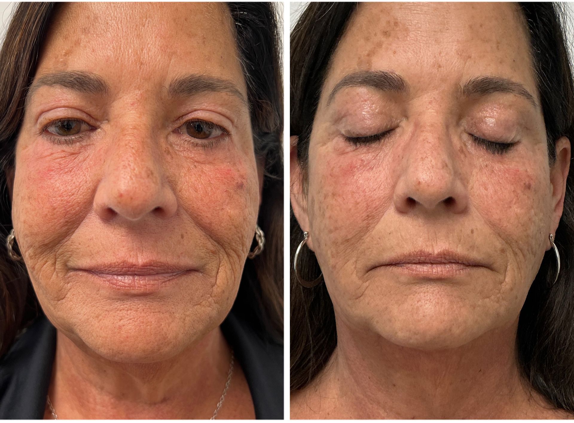 Two photos of a woman's face, open and closed eyes, before and after a procedure, with reduced wrinkles.