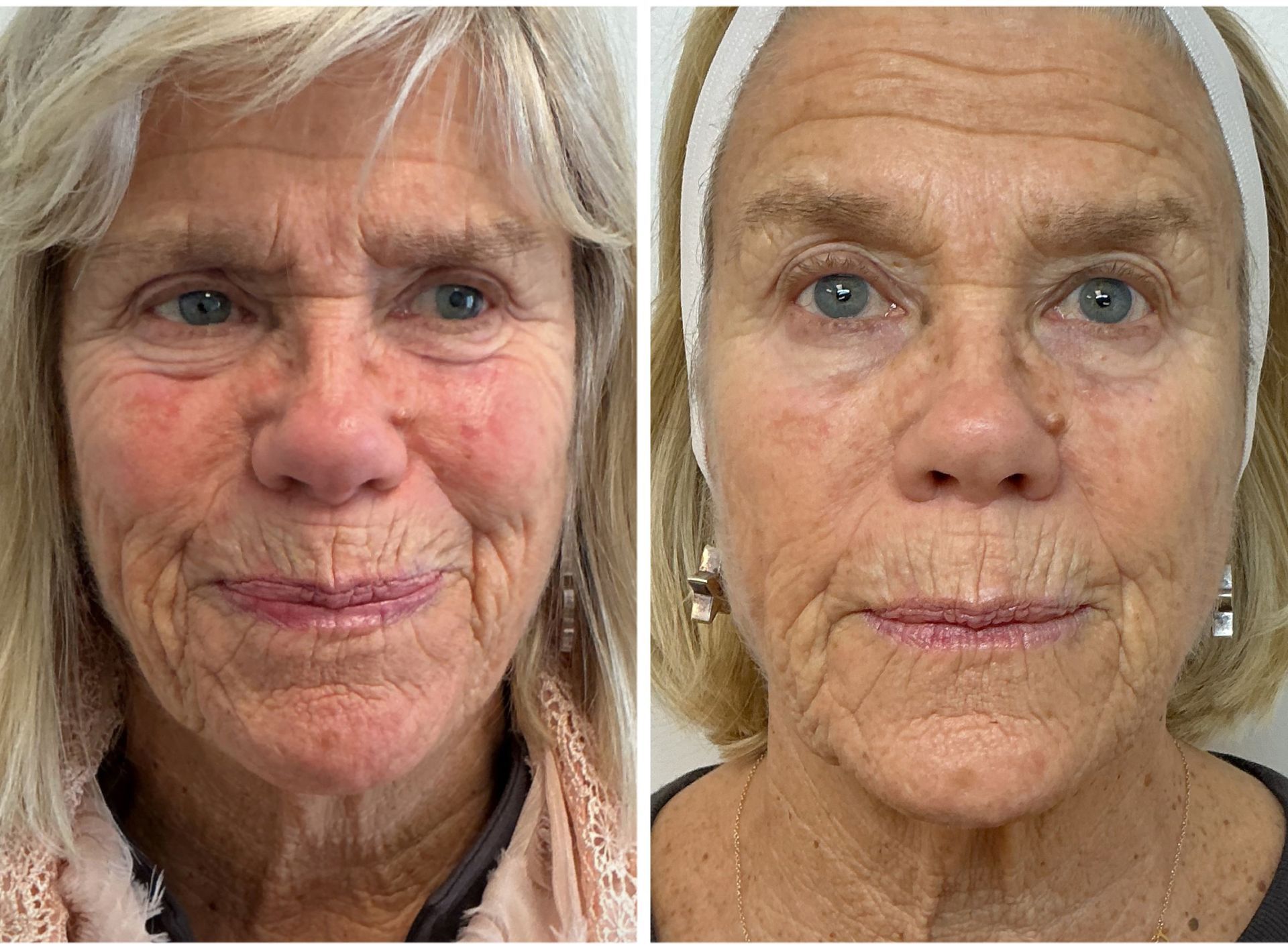 Before-and-after facial comparison: a woman with wrinkles and redness on the left, smoother skin on the right.