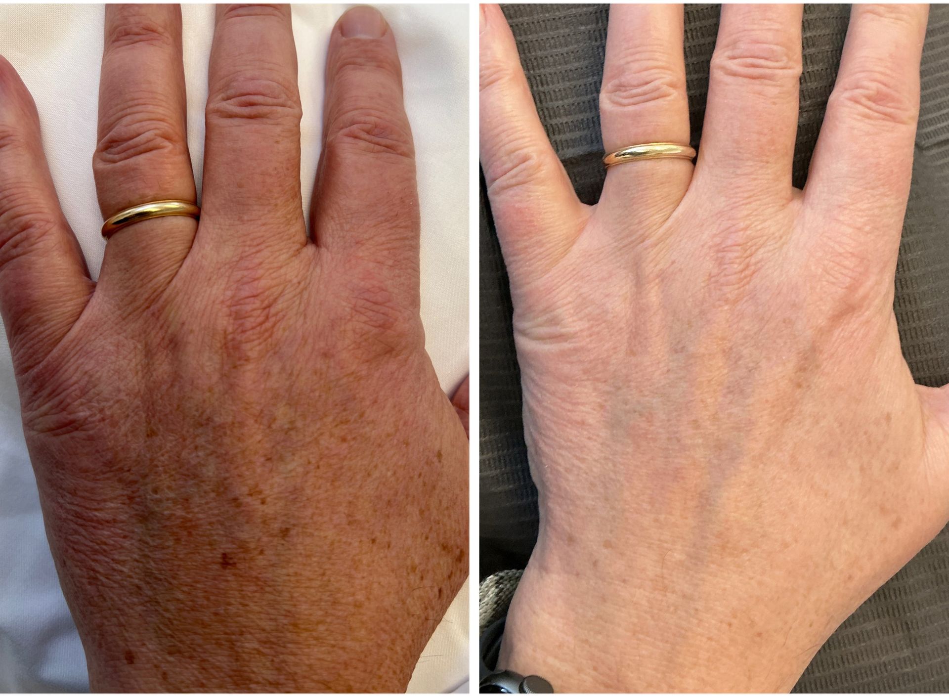 Two hands, left with dark spots and discoloration, right with improved skin tone.