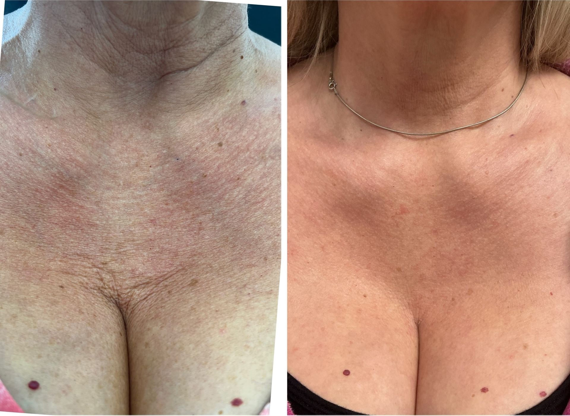Side-by-side comparison of a person's chest. Left side: wrinkled skin. Right side: smoother skin.