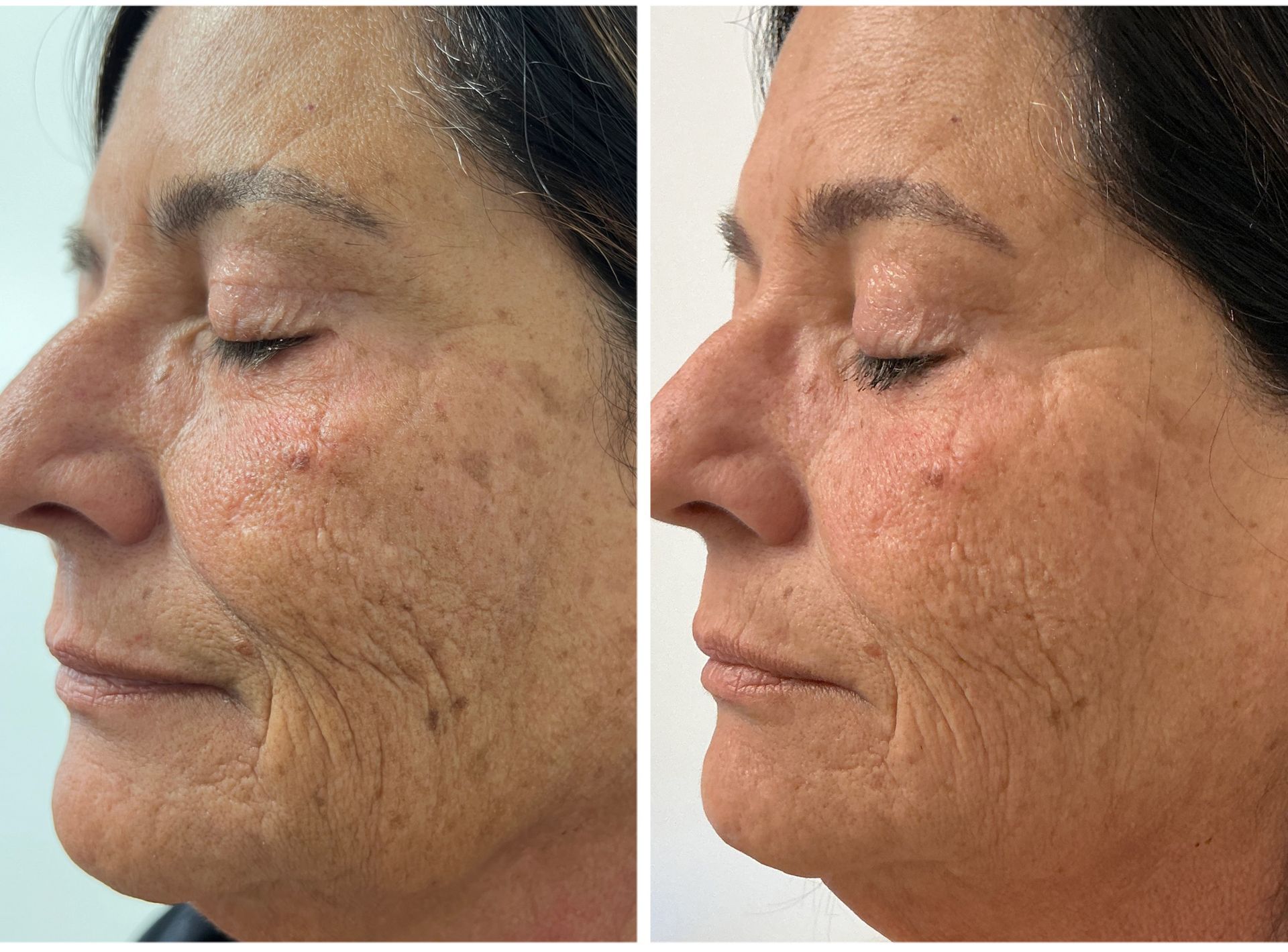 Side-by-side view of a woman's face, before and after a skin treatment, showing reduced wrinkles and improved skin texture.