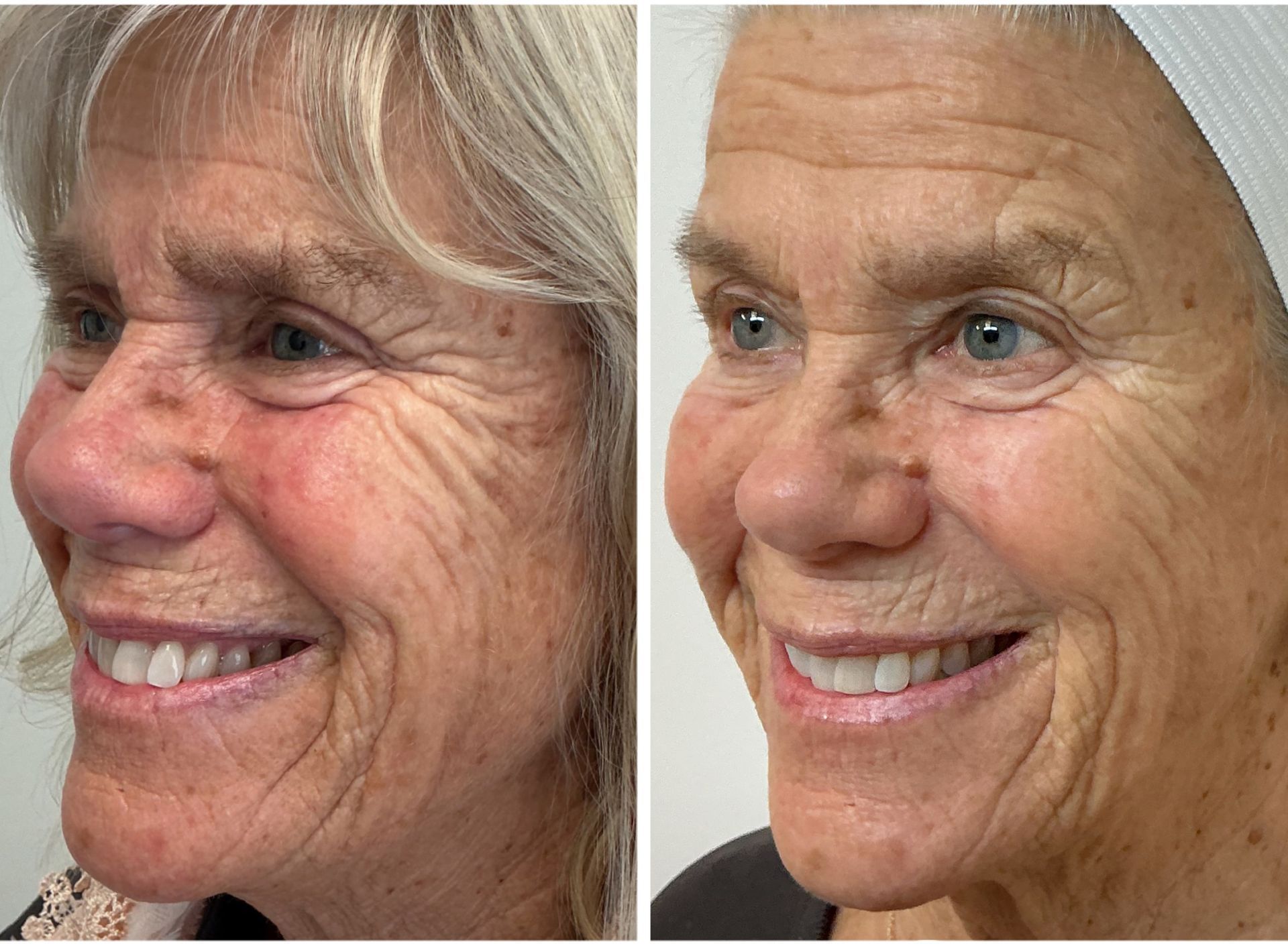 Comparison photo: older woman's face before and after treatment, showing fewer wrinkles and smoother skin.