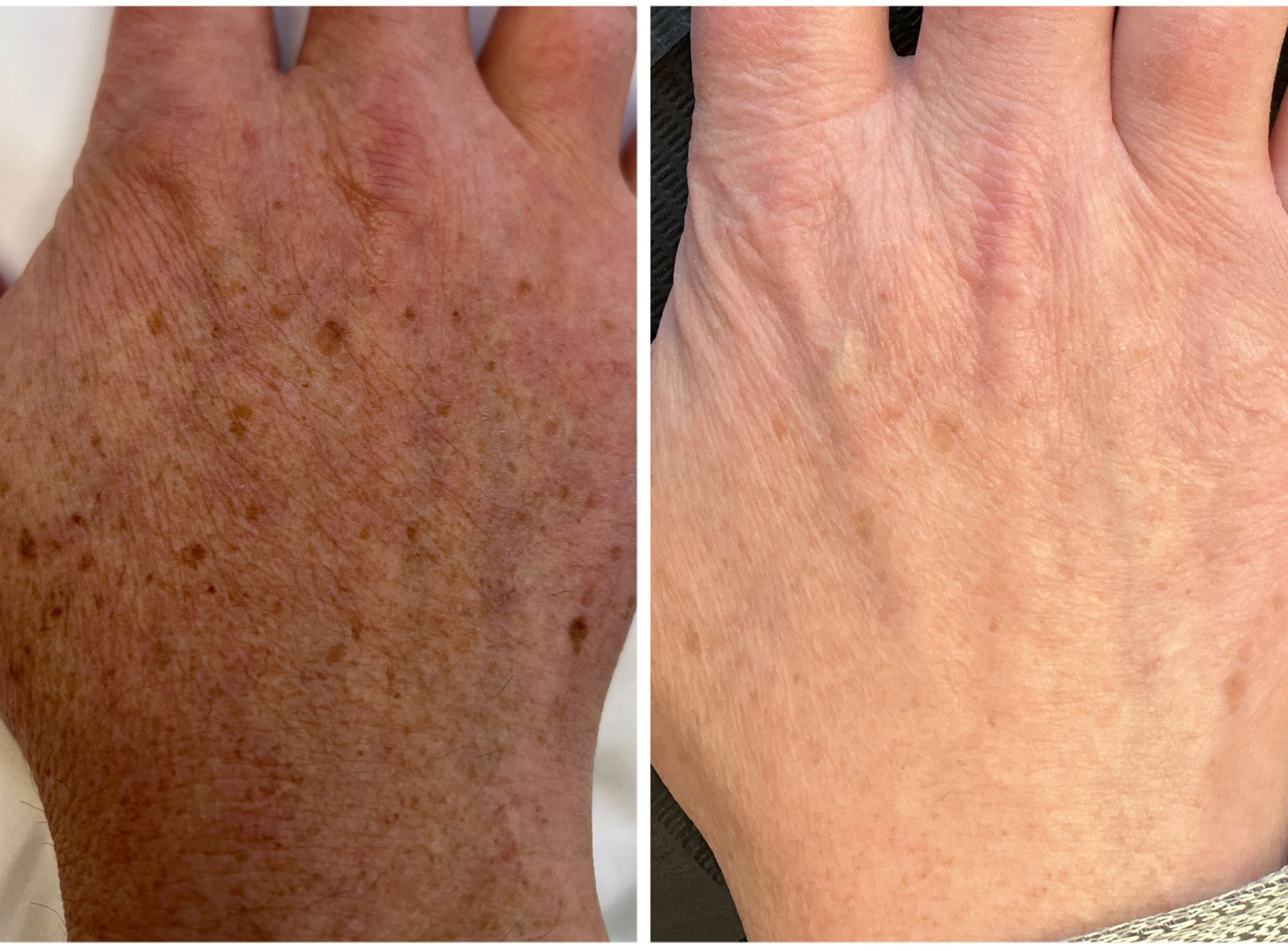 Two hands side-by-side, one with many brown age spots, the other with fewer spots and lighter skin.