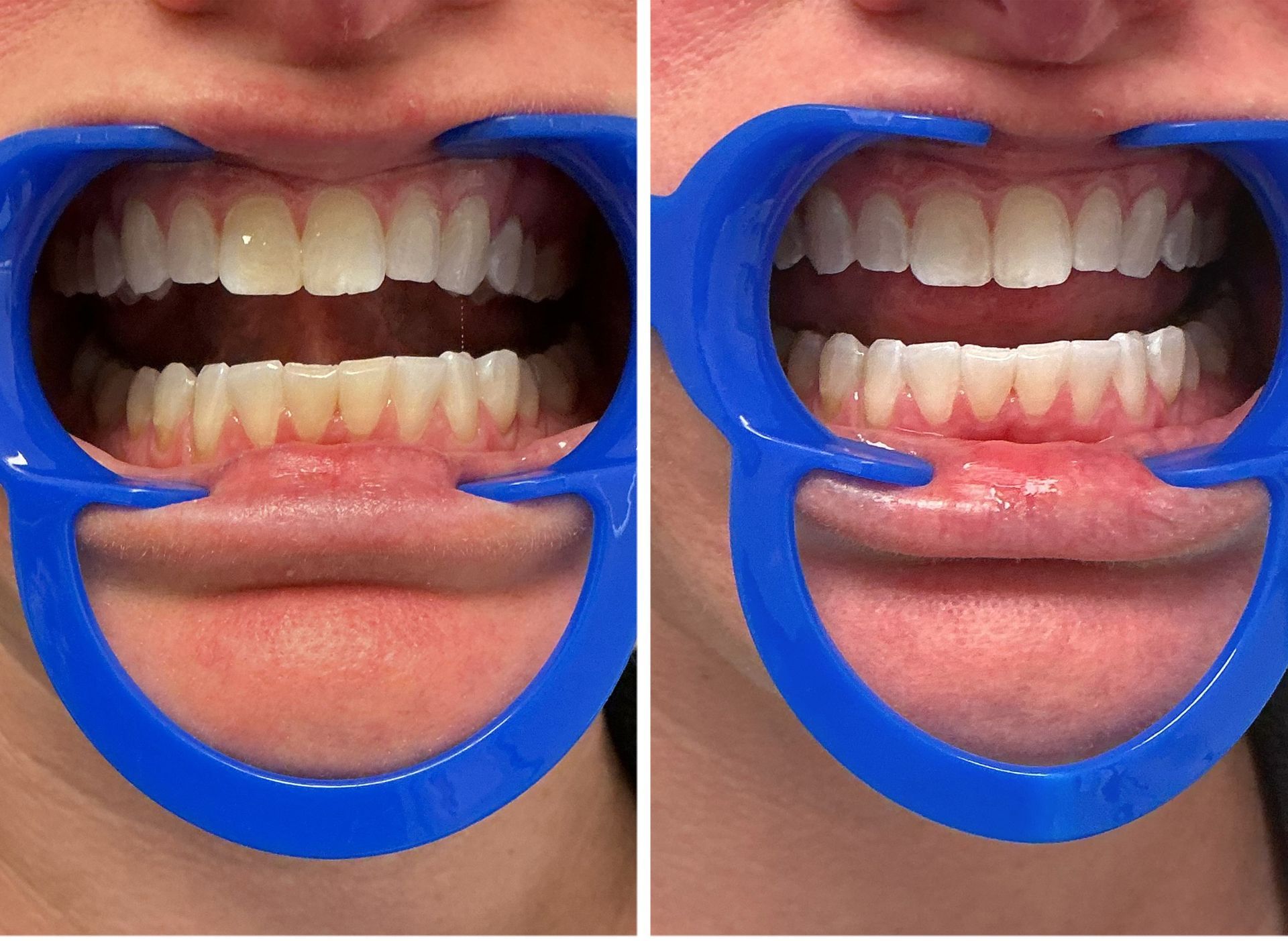 Side-by-side teeth comparison: yellowish teeth on the left, bright white teeth on the right, both using blue mouth retractors.