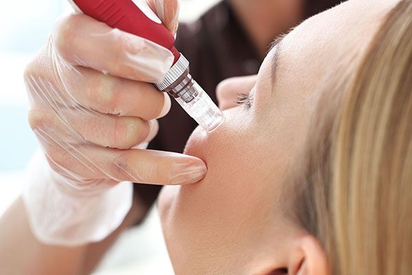 A woman is getting a microneedle treatment on her face.