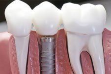 Dental  Implants