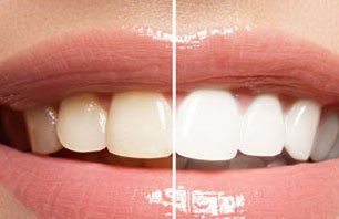 teeth white