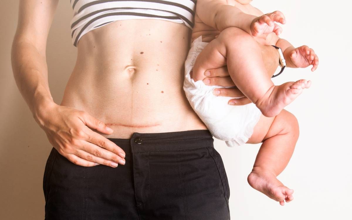 Woman holding baby, revealing C-section scar, wearing striped top and black pants.