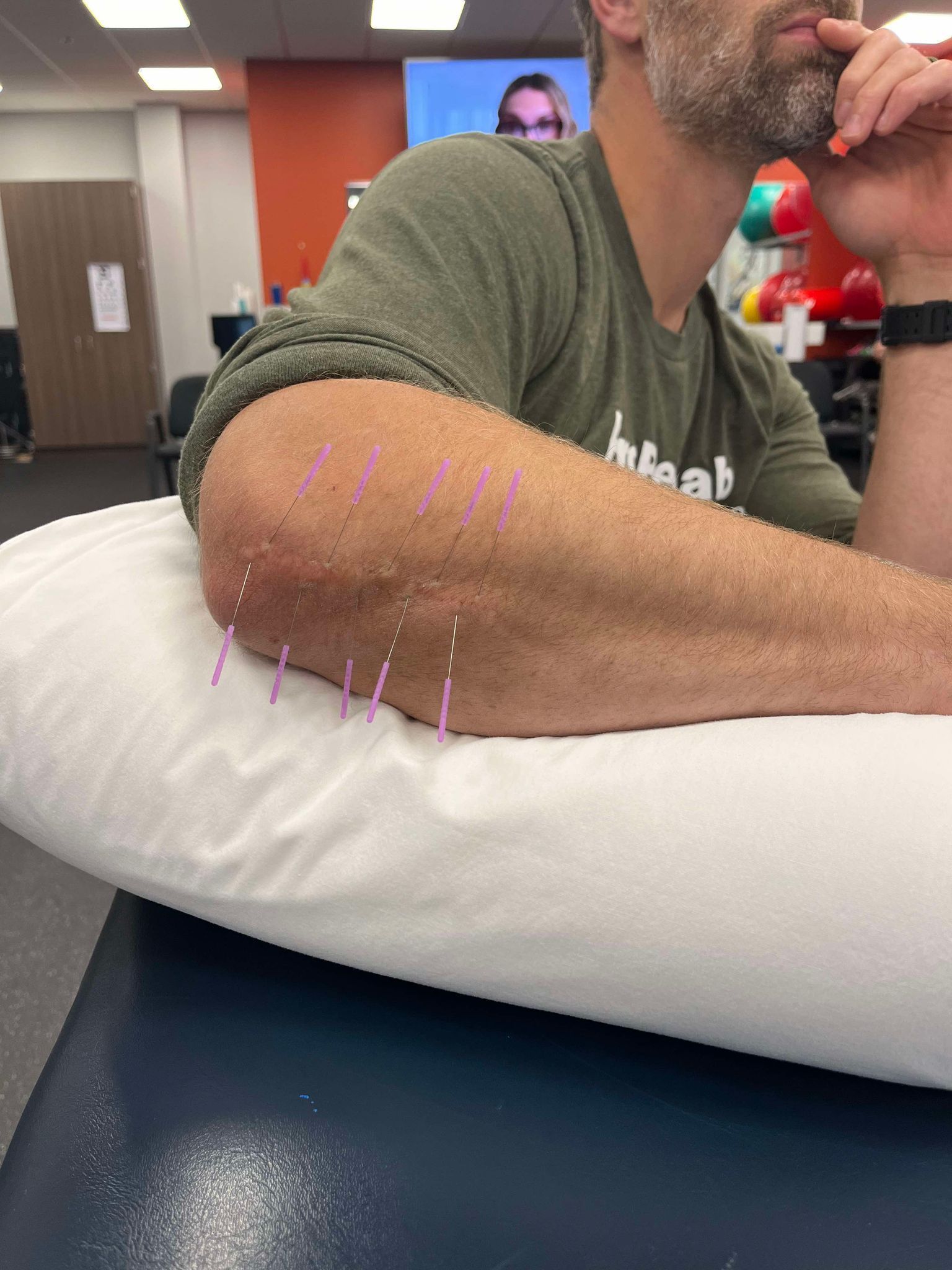 Man's arm on a pillow, receiving acupuncture treatment with needles inserted into the elbow area.