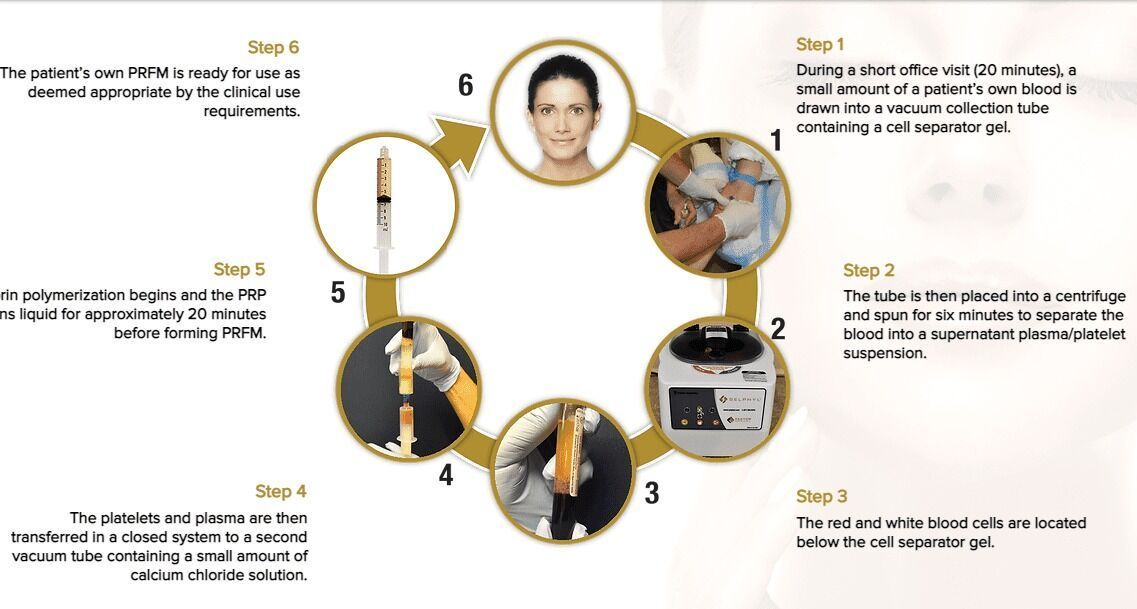 Diagram of a cosmetic procedure: a woman, syringes, and steps like preparing the skin and injecting a substance.