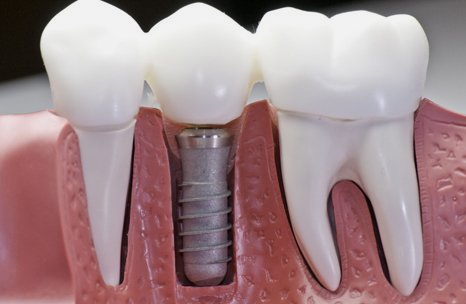 Implant dentistry model