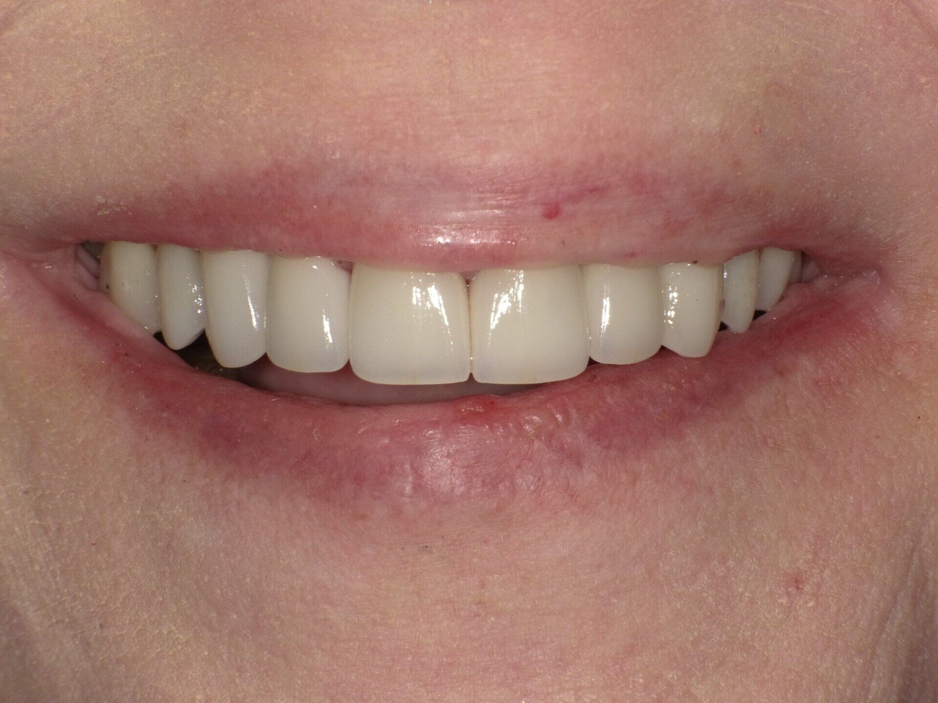 crowns/veneers after 5