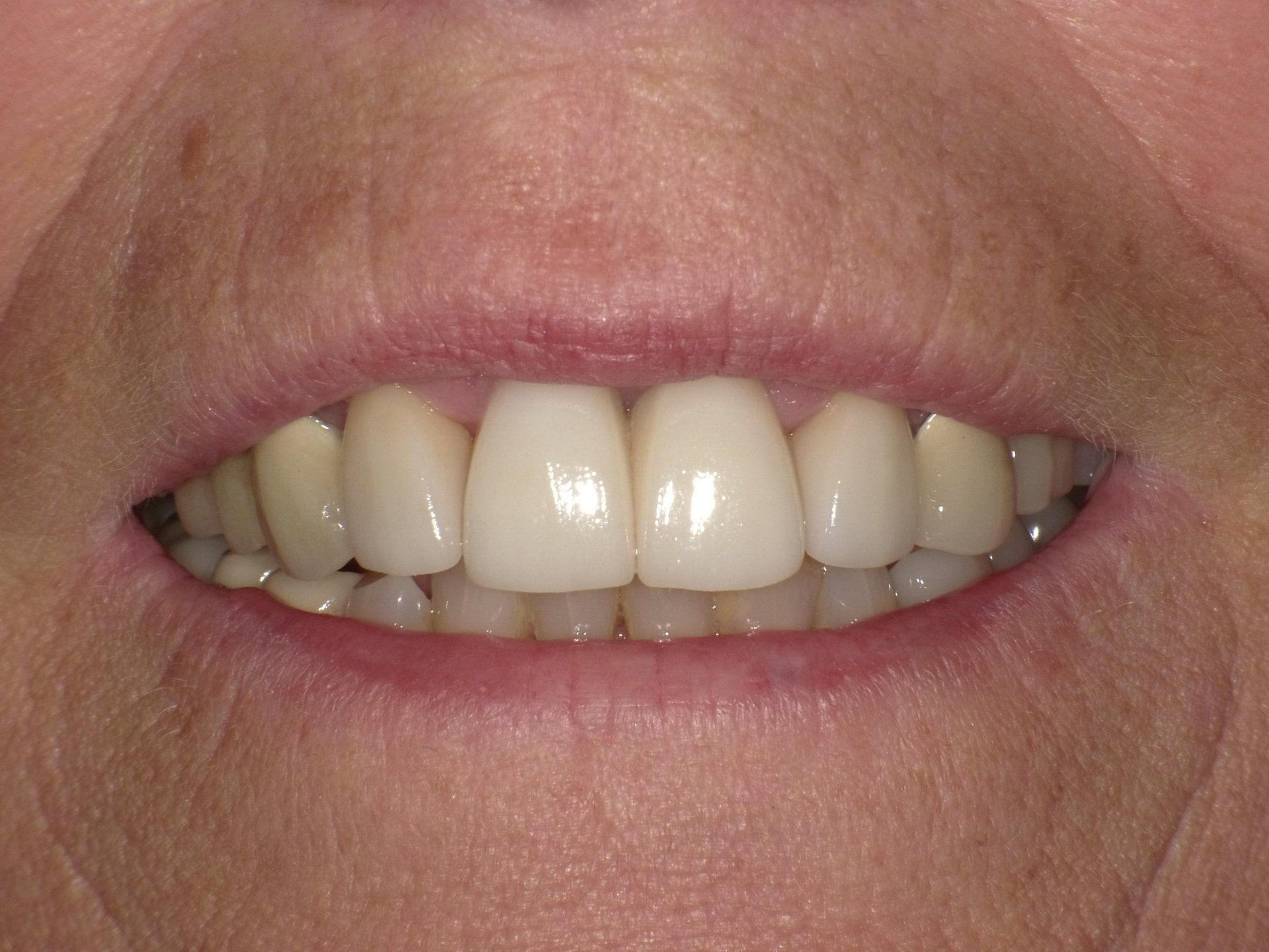 crowns/veneers after 7