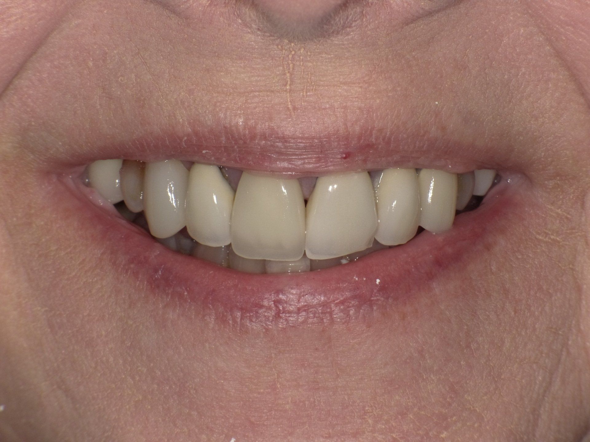 crowns/veneers before 5