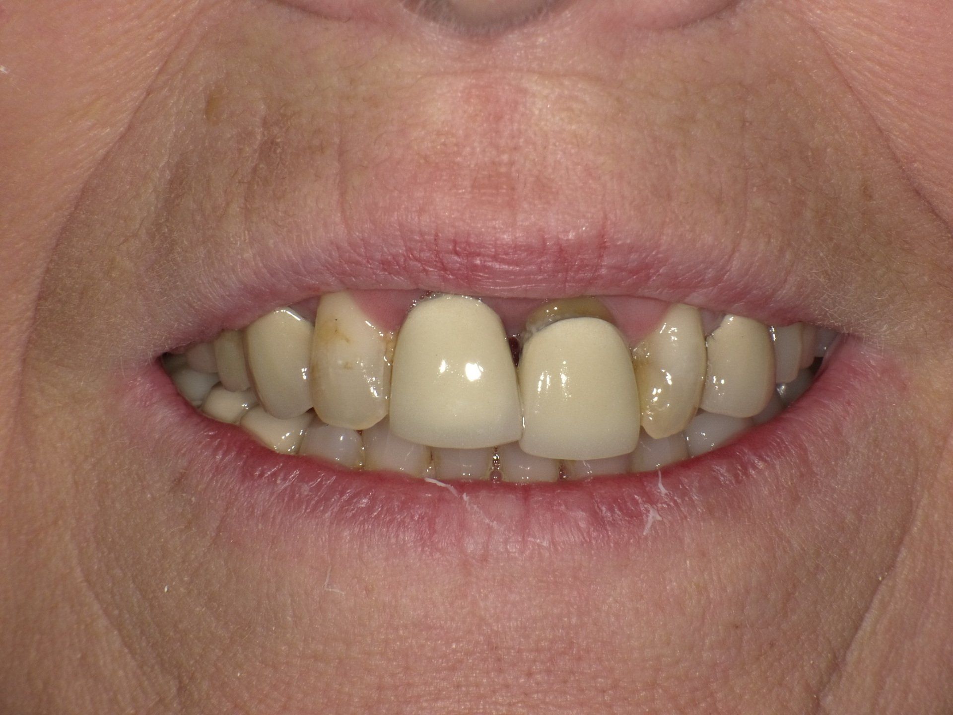 crowns/veneers before 6