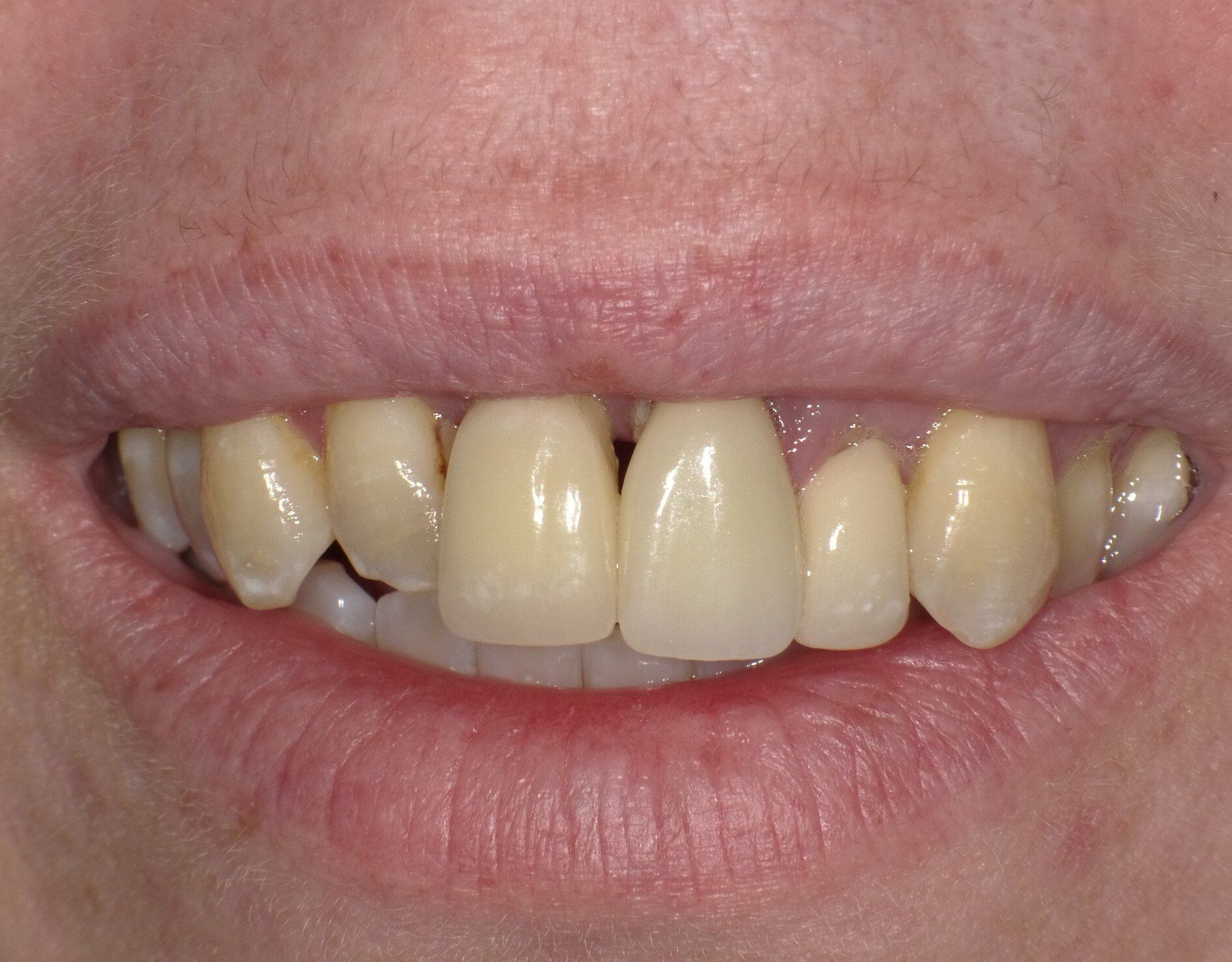 crowns/veneers before 10