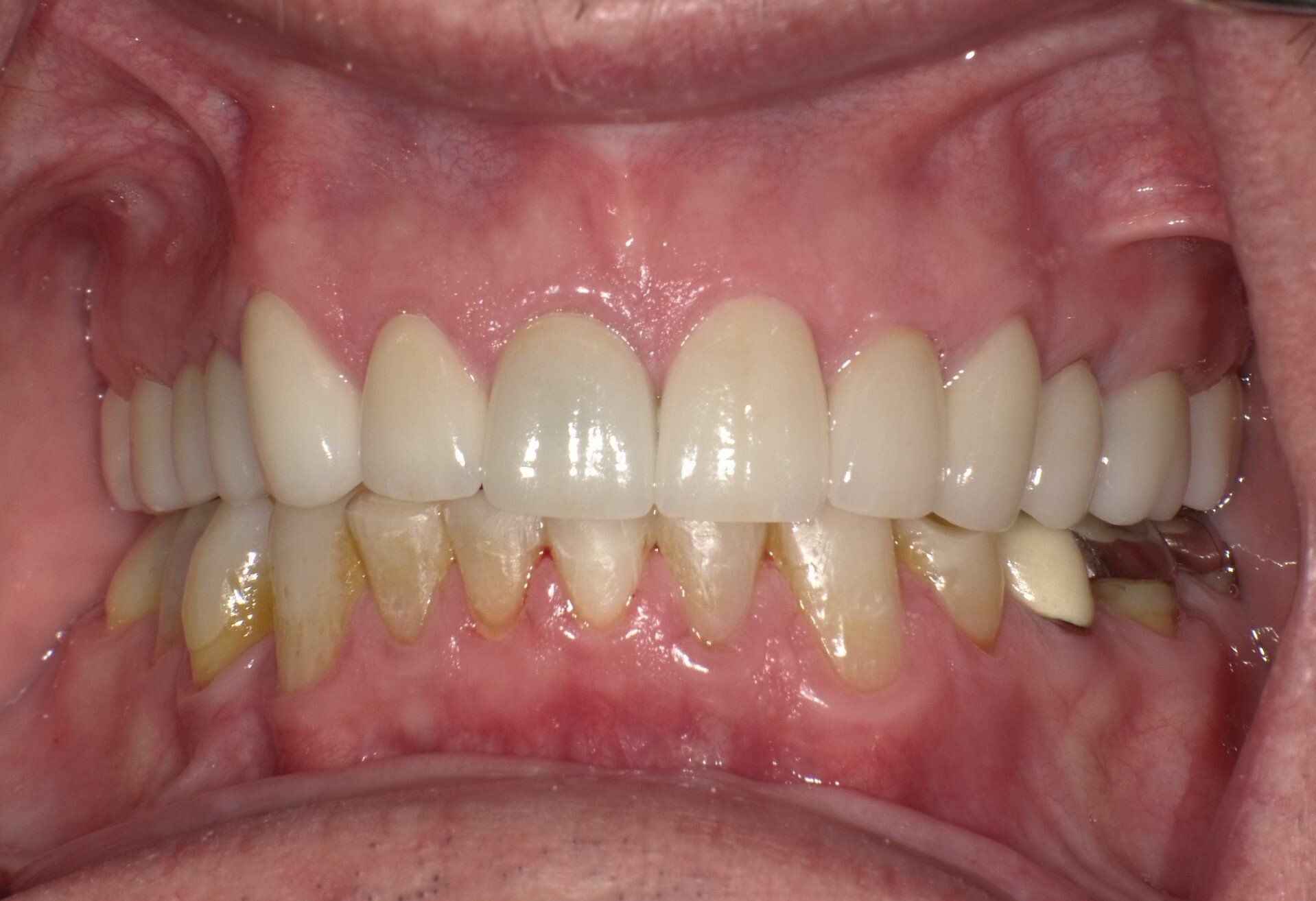 crowns/veneers after 9