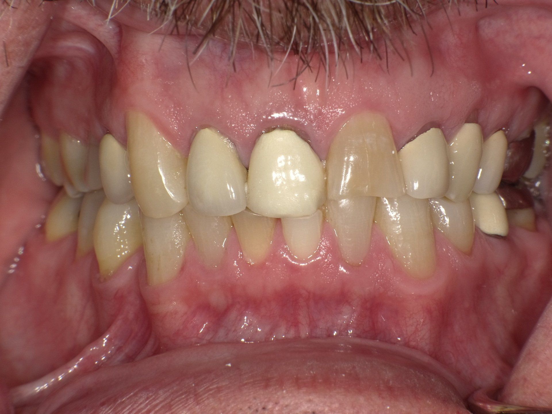 crowns/veneers before 8
