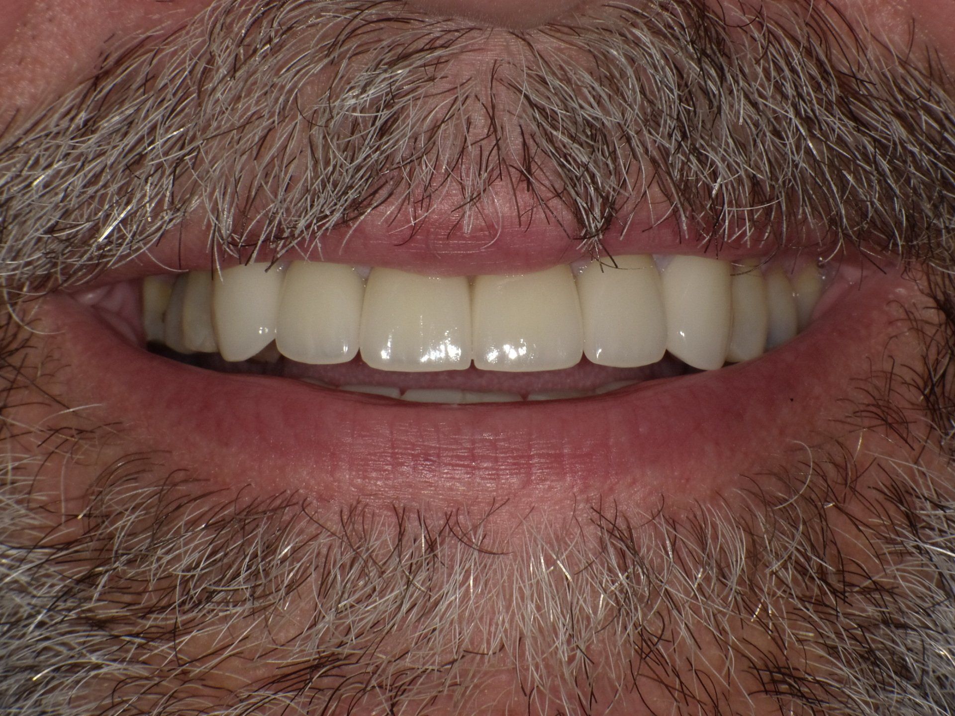 crowns/veneers after 11