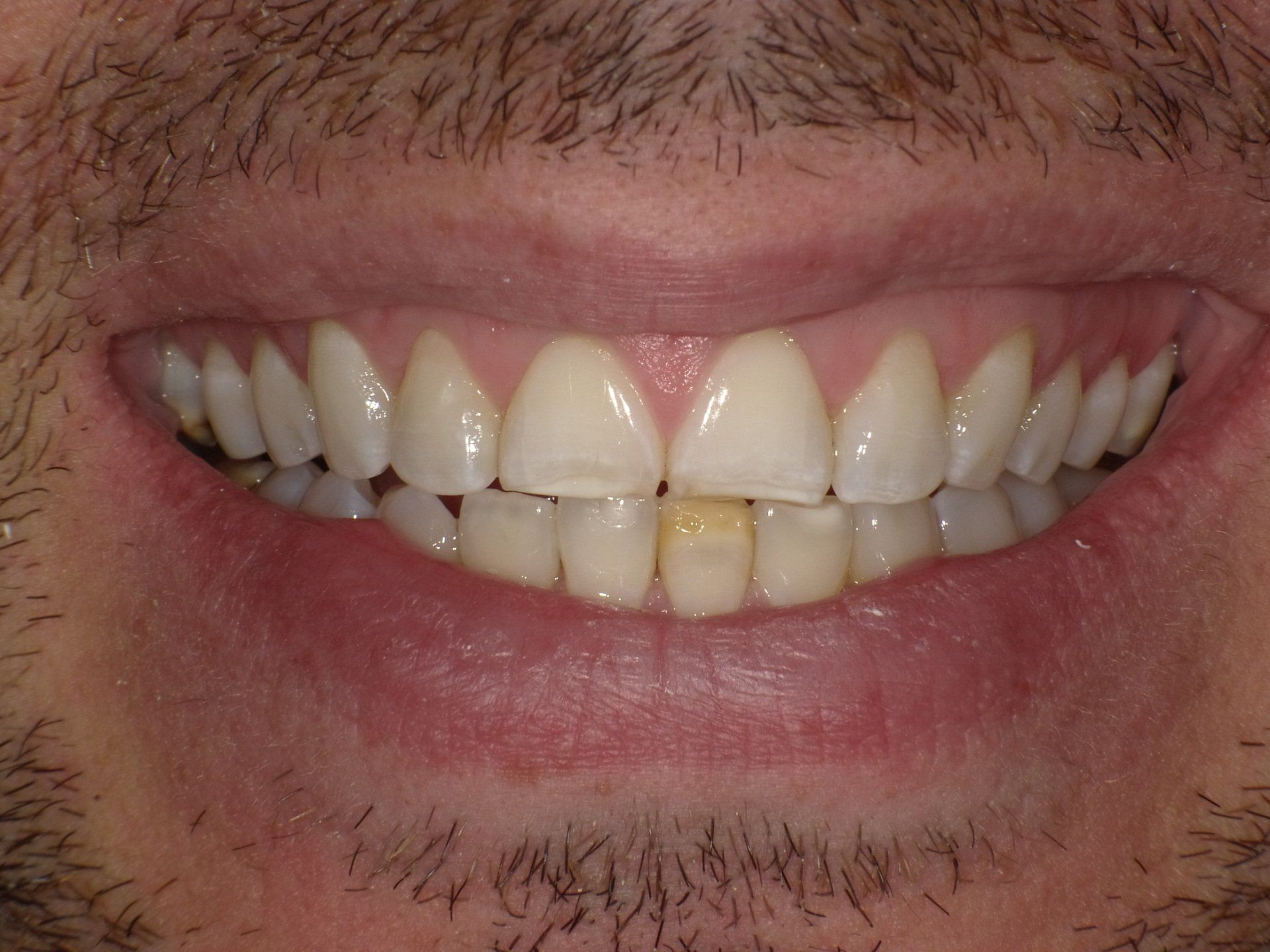 crowns/veneers before 11
