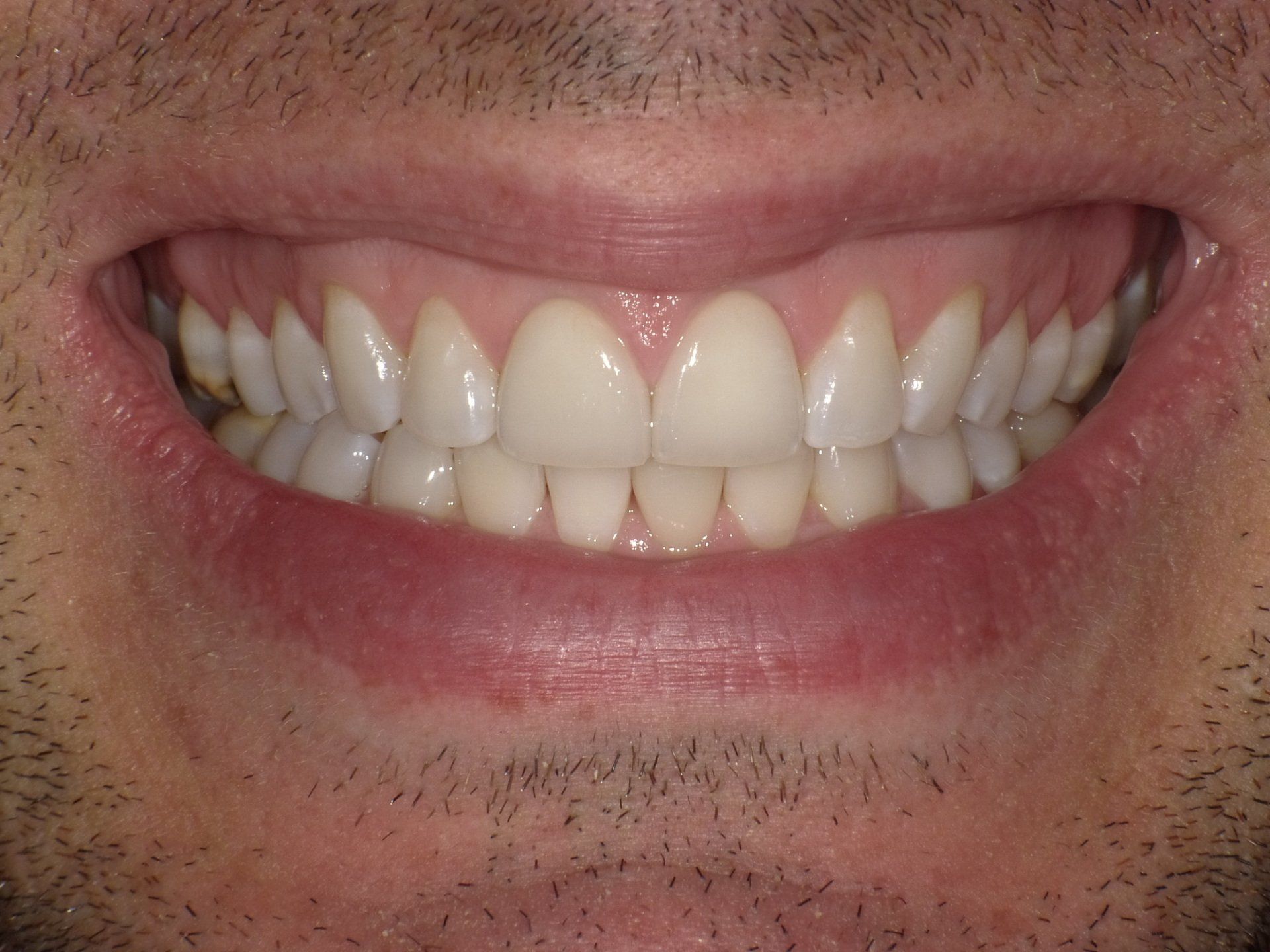 crowns/veneers after 11