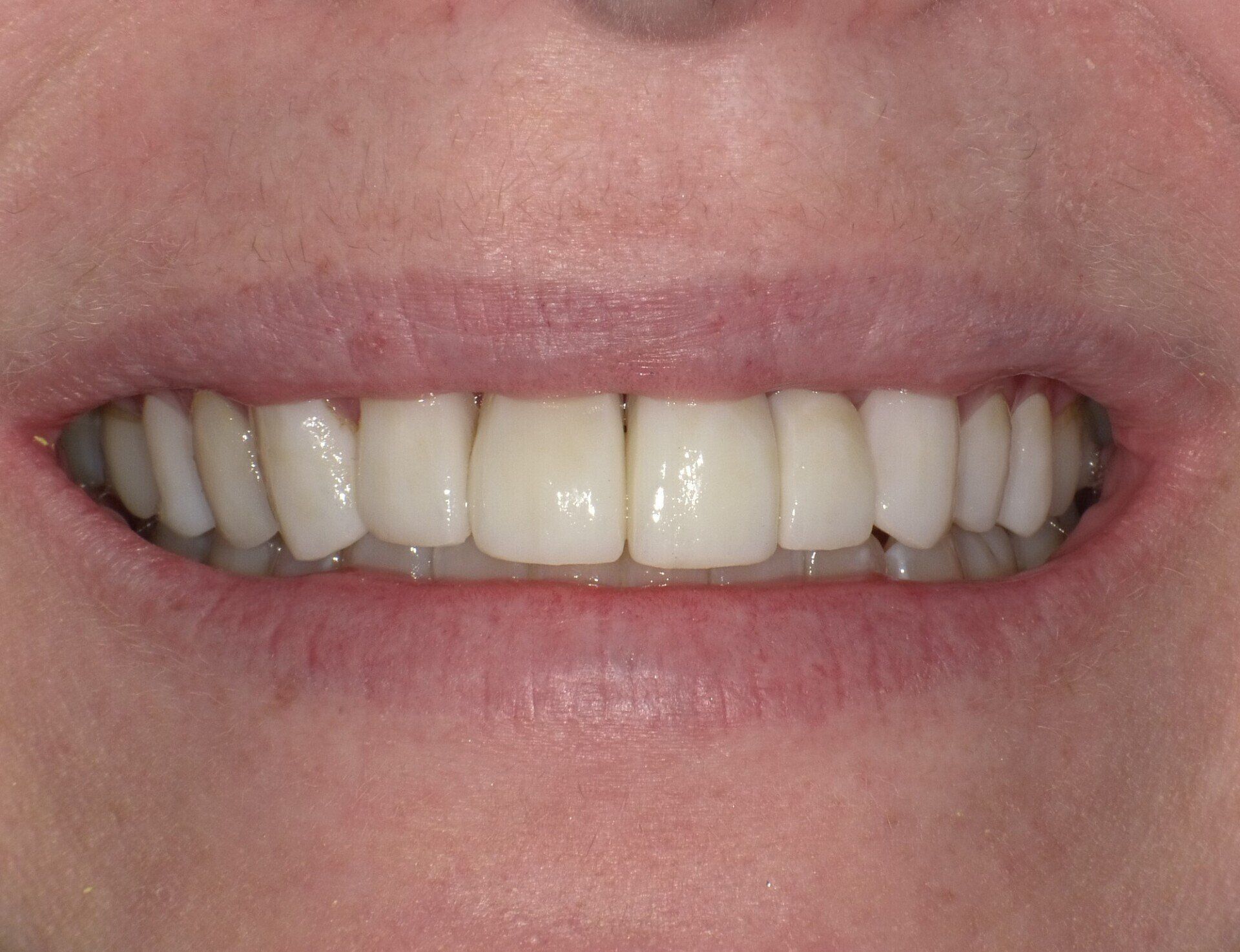 crowns/veneers after 10