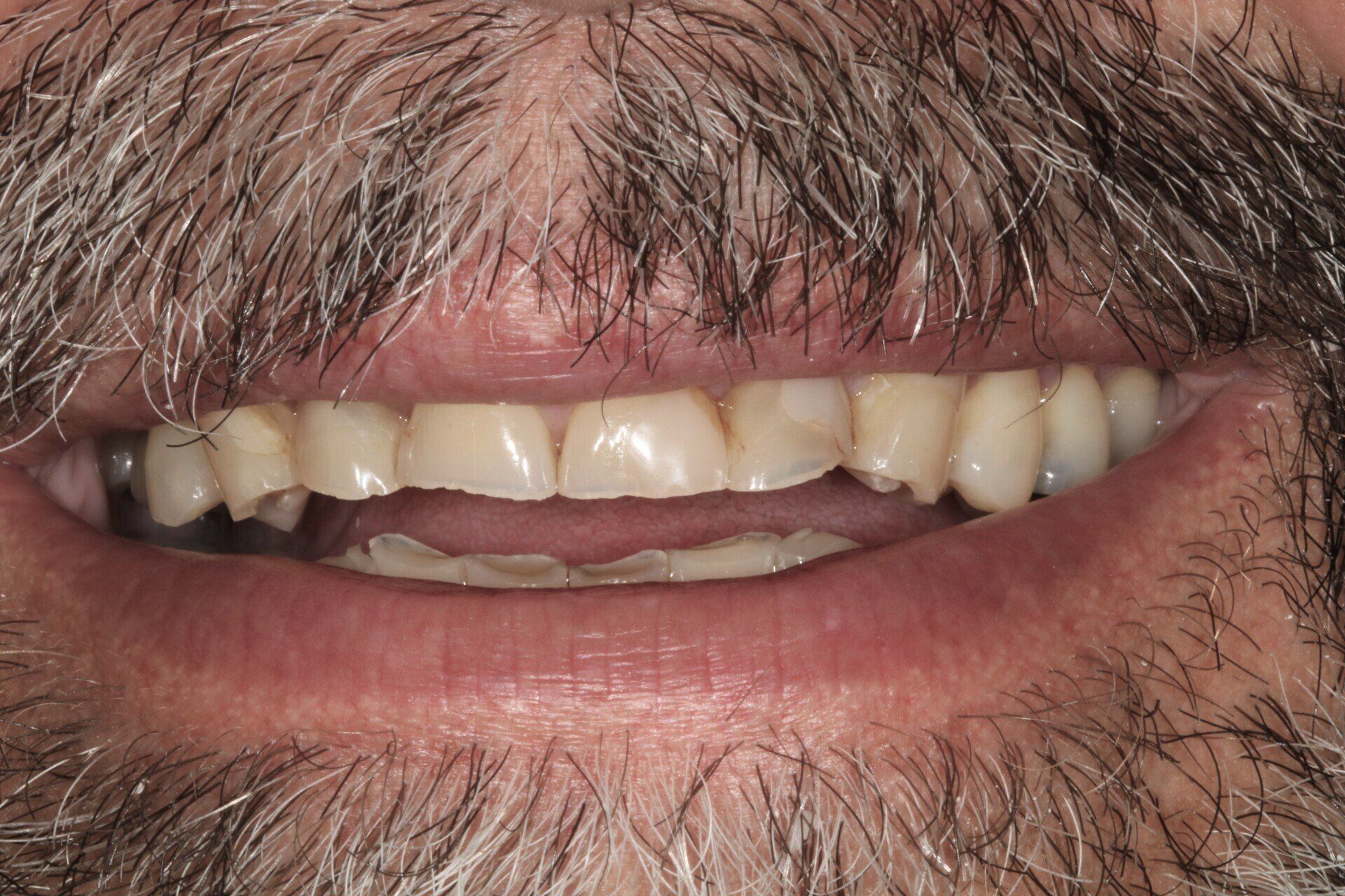 crowns/veneers before 11