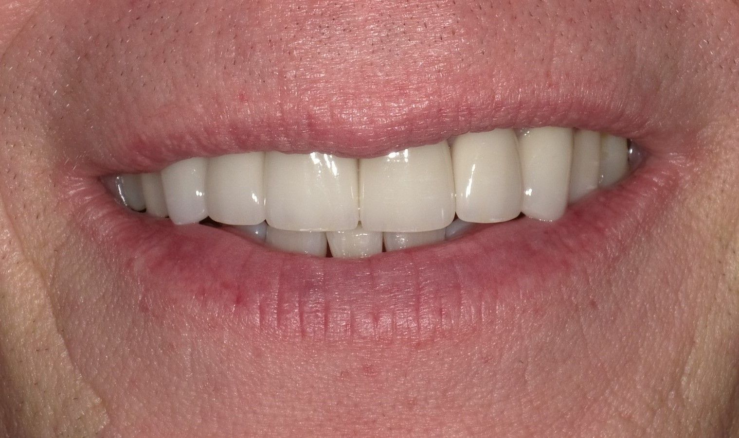 crowns/veneers after 2