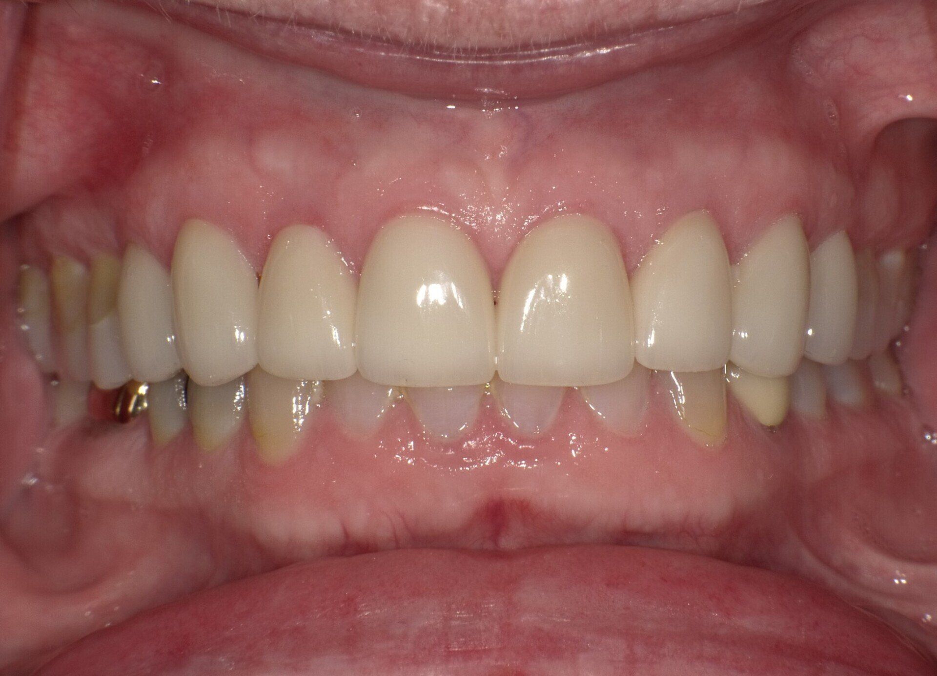 crowns/veneers after 3