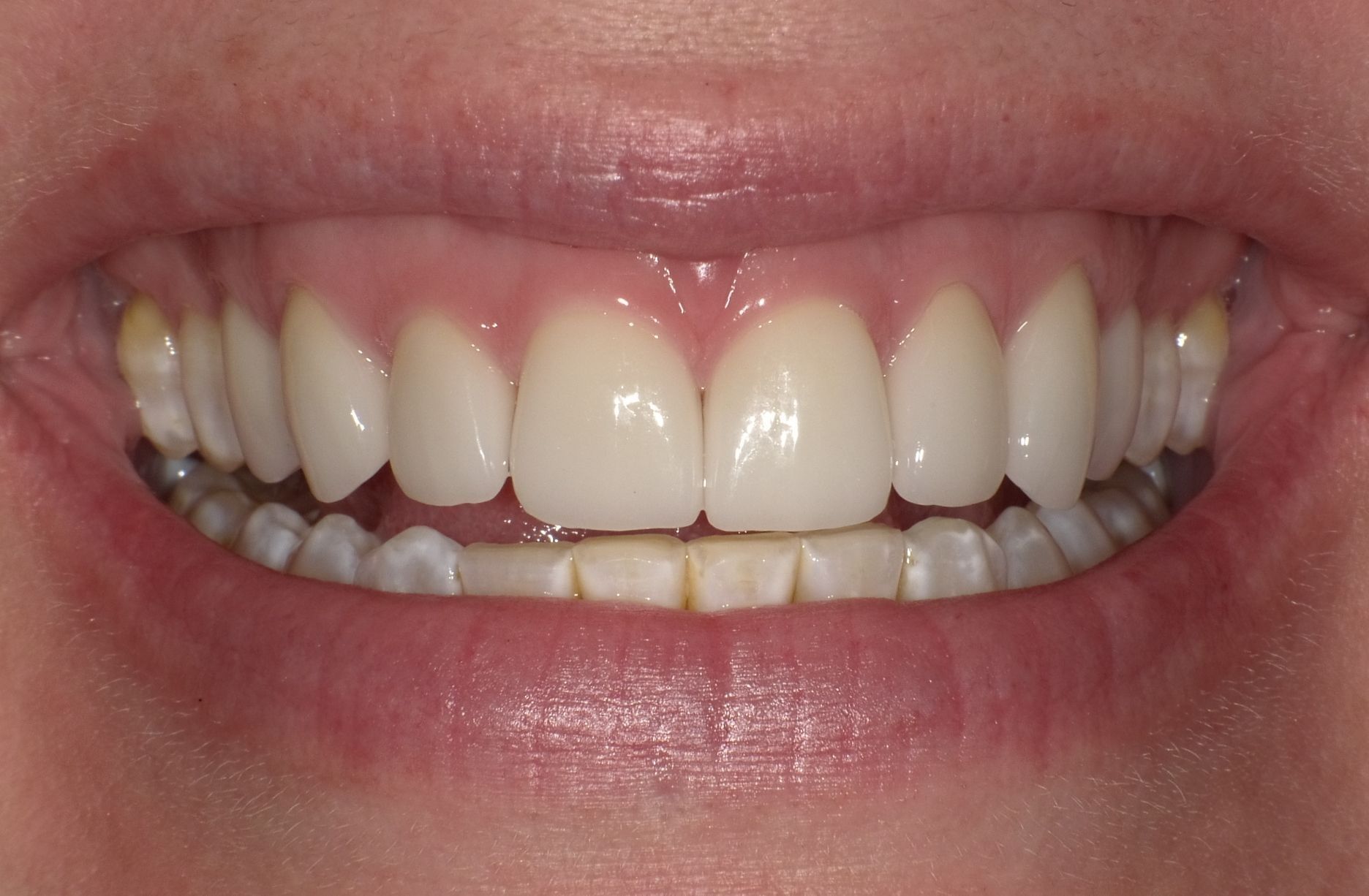 crowns/veneers after 1
