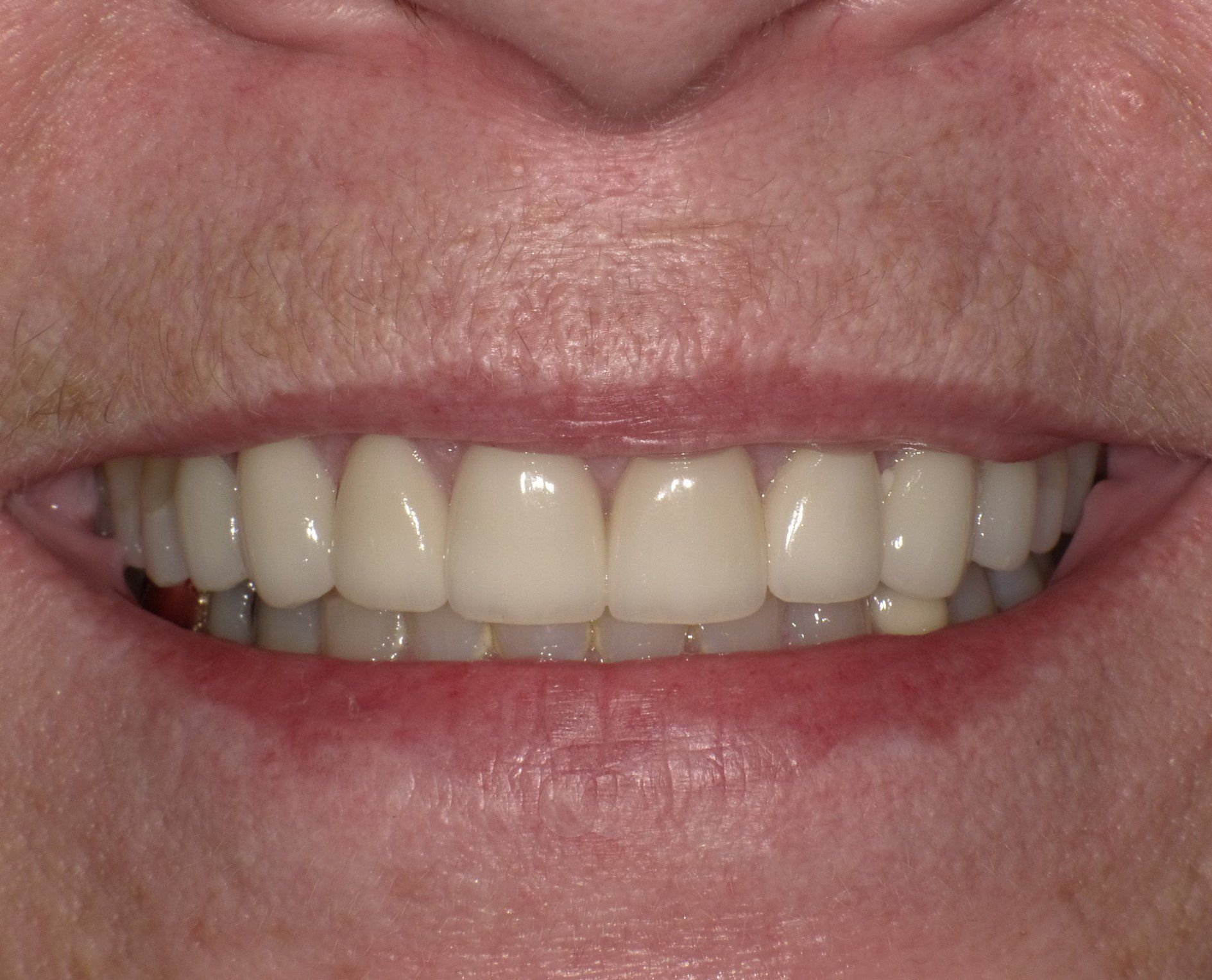 crowns/veneers after 4
