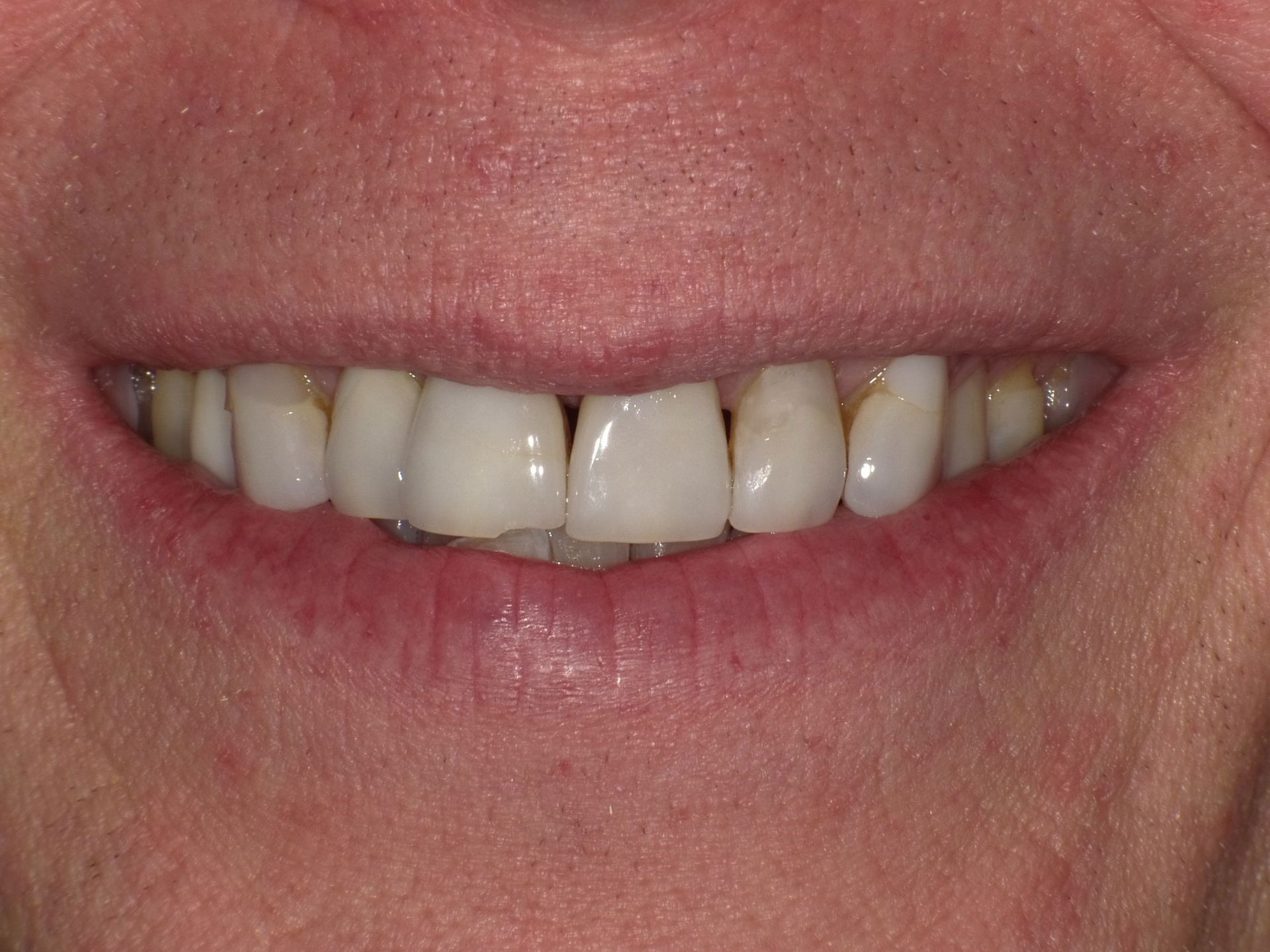 crowns/veneers before 2