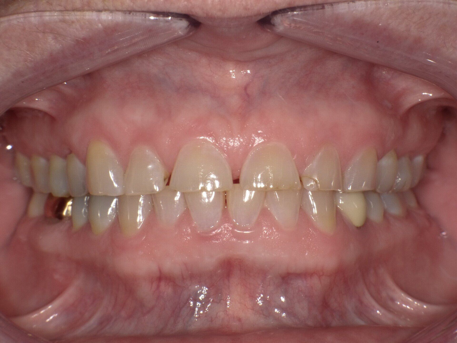crowns/veneers before 3