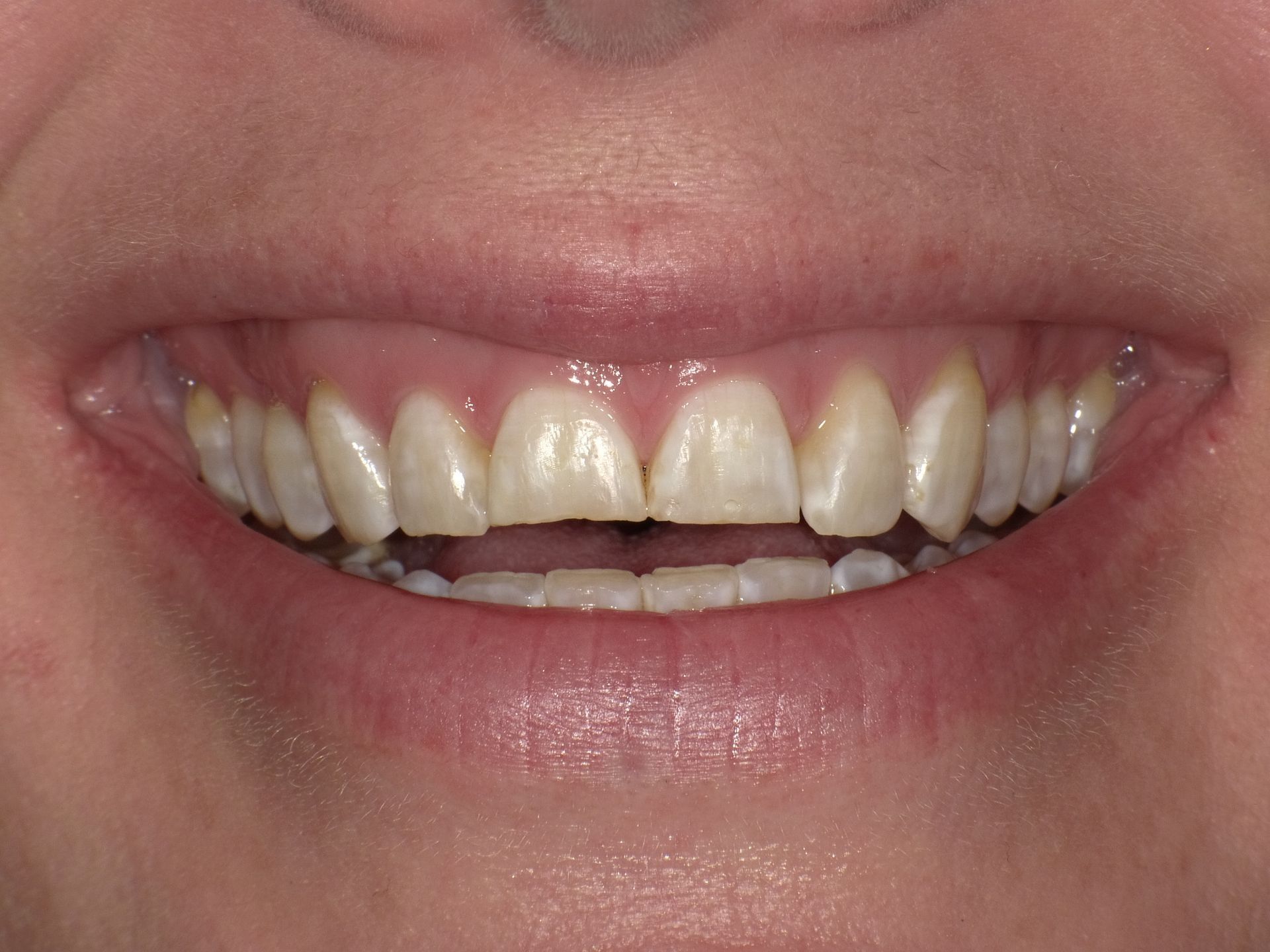crowns/veneers before 1