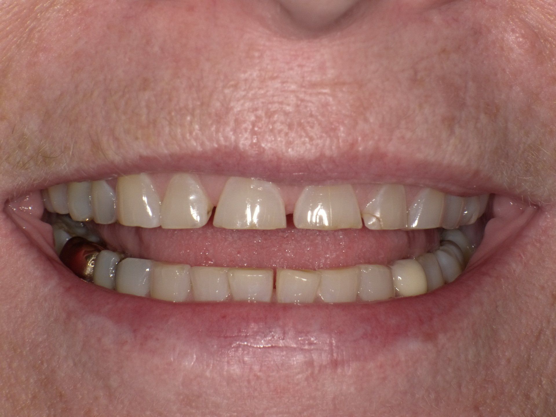 crowns/veneers before 4