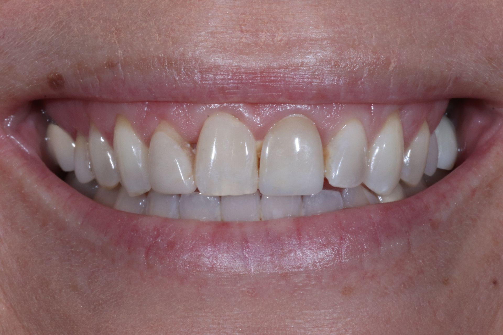 crowns/veneers before smile