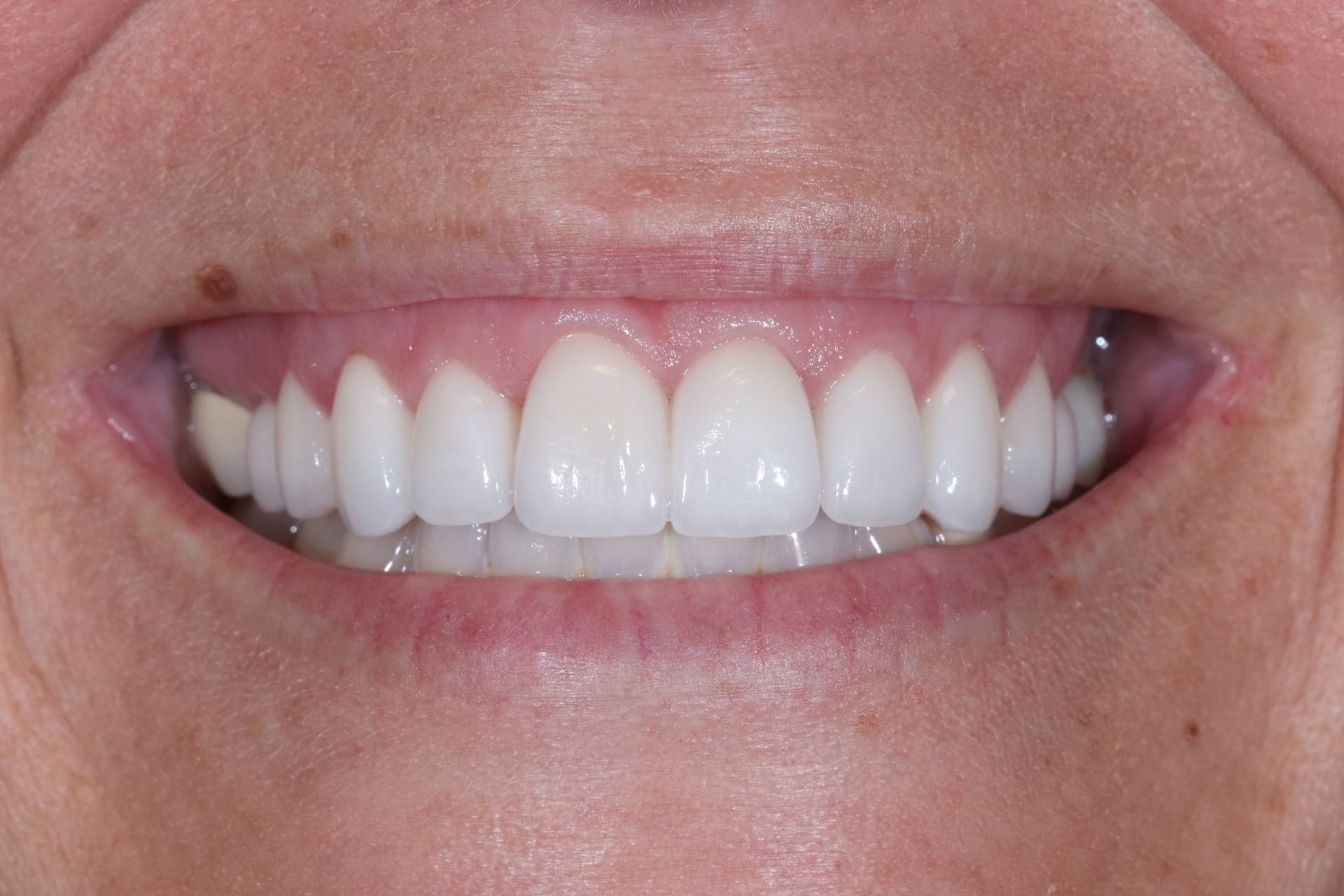 crowns/veneers after smile