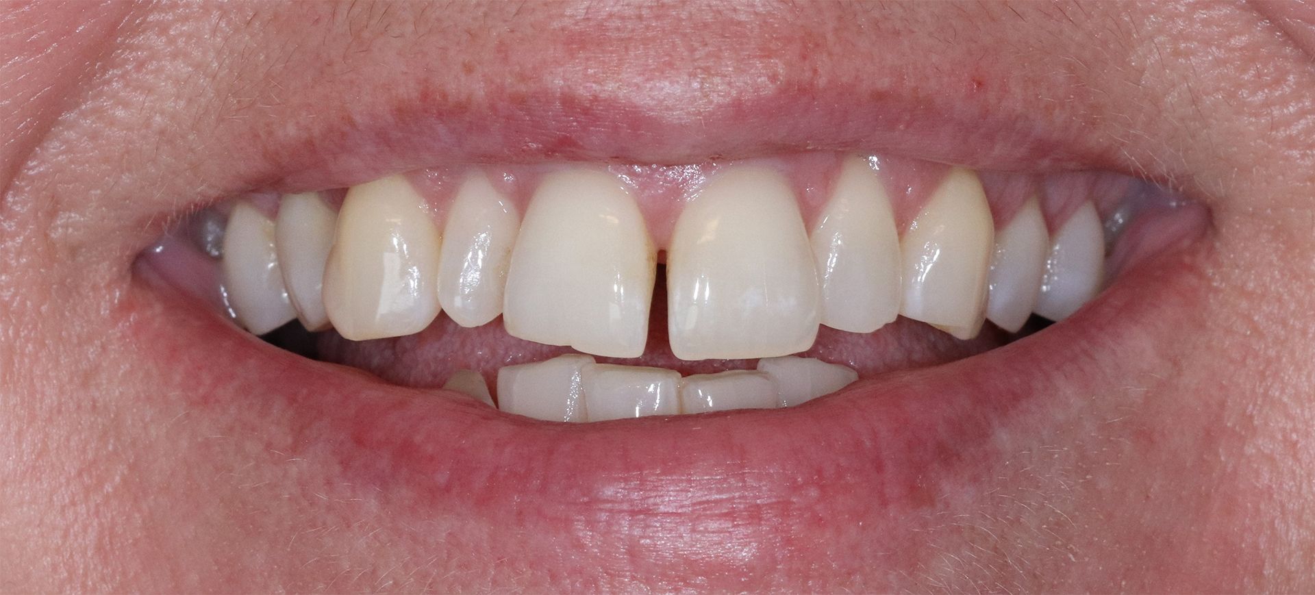 crowns/veneers before smile
