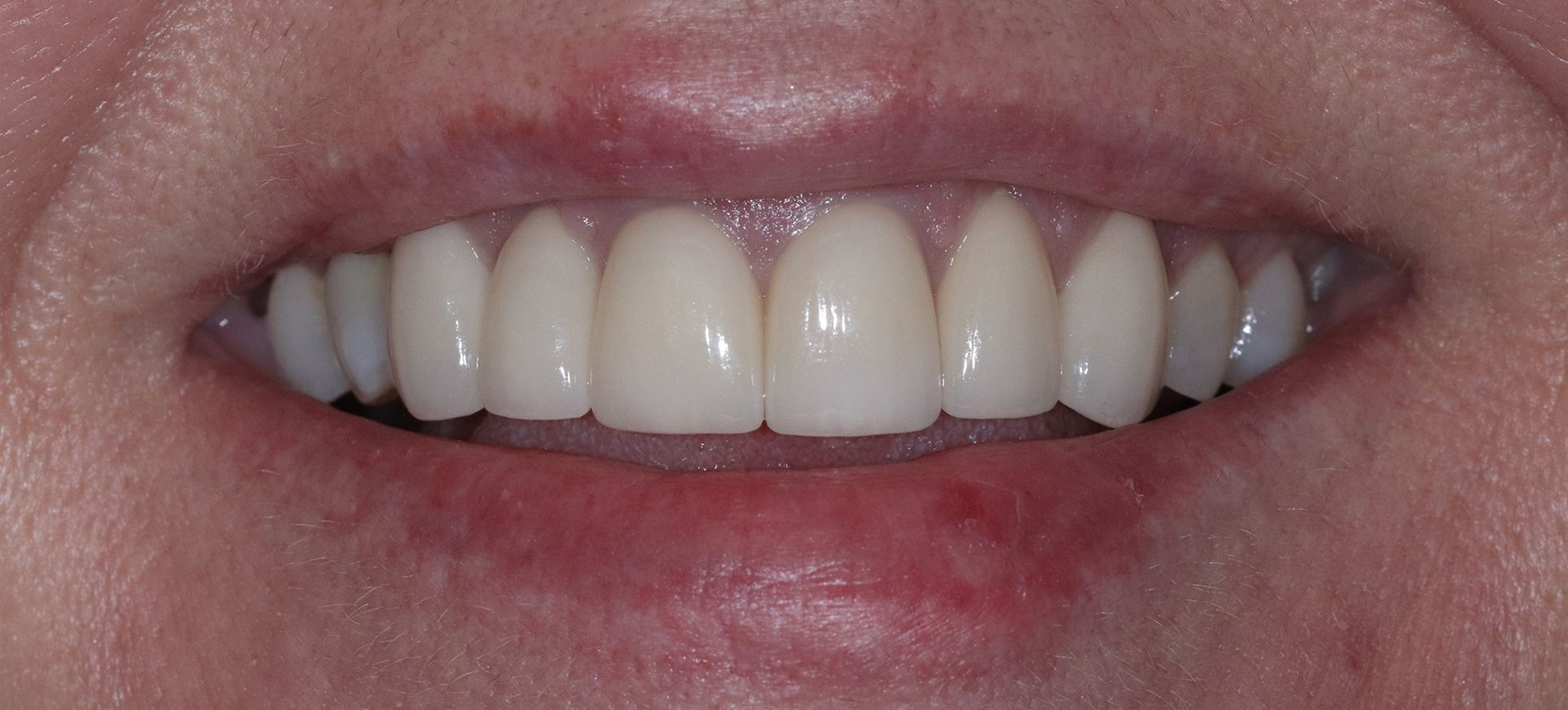 crowns/veneers after smile
