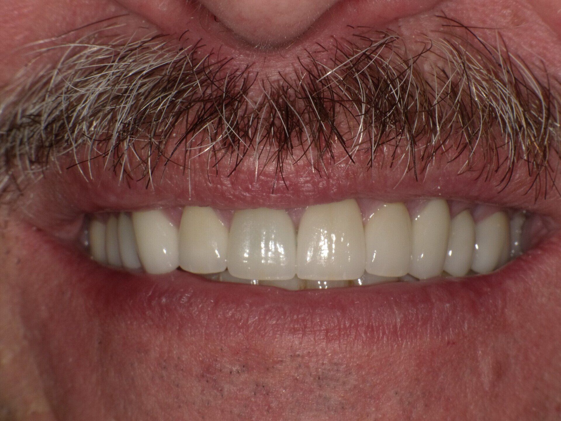 crowns/veneers after 10