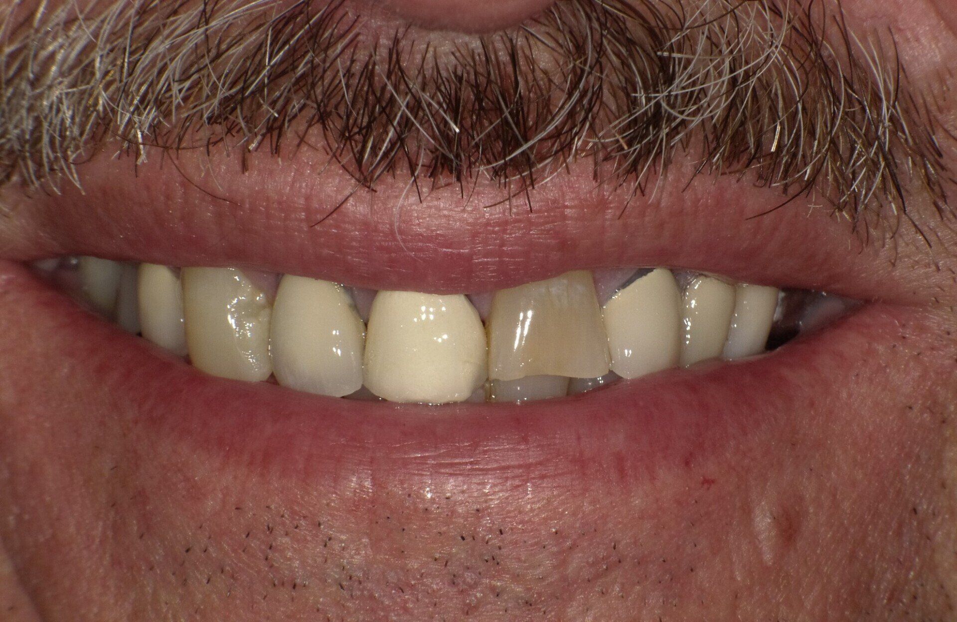 crowns/veneers before 10