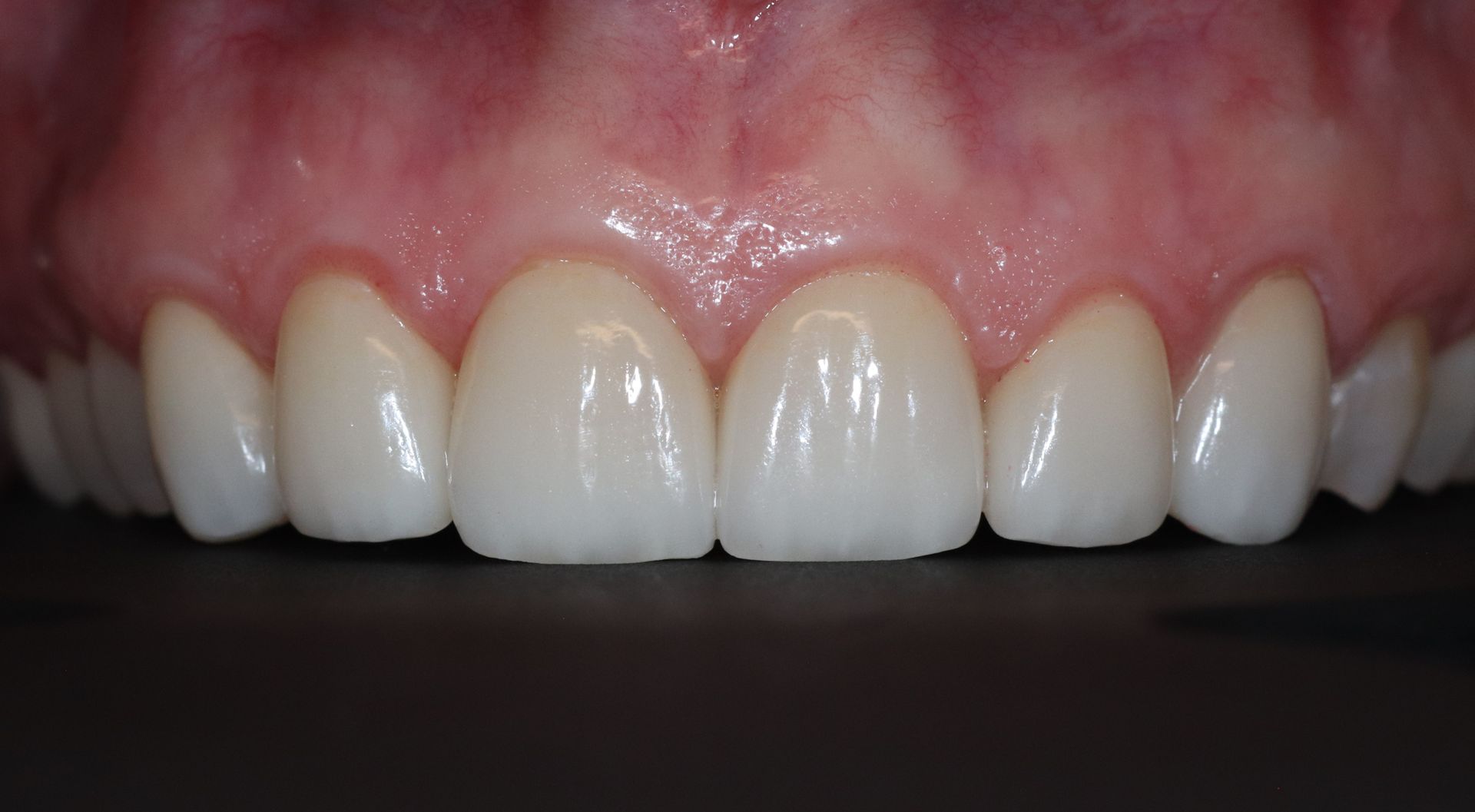 AFTER: Close-up of upper front teeth and pink gums with a slight gap between the central incisors.