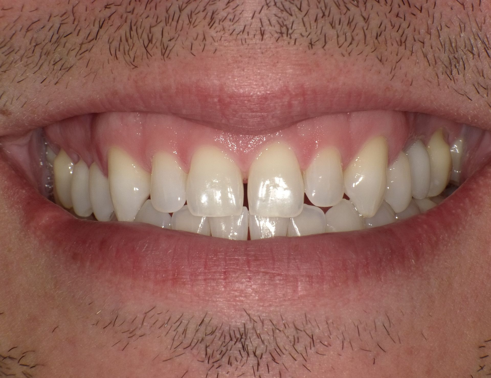 BEFORE: Close-up of a smiling mouth showing straight white teeth and pink gums