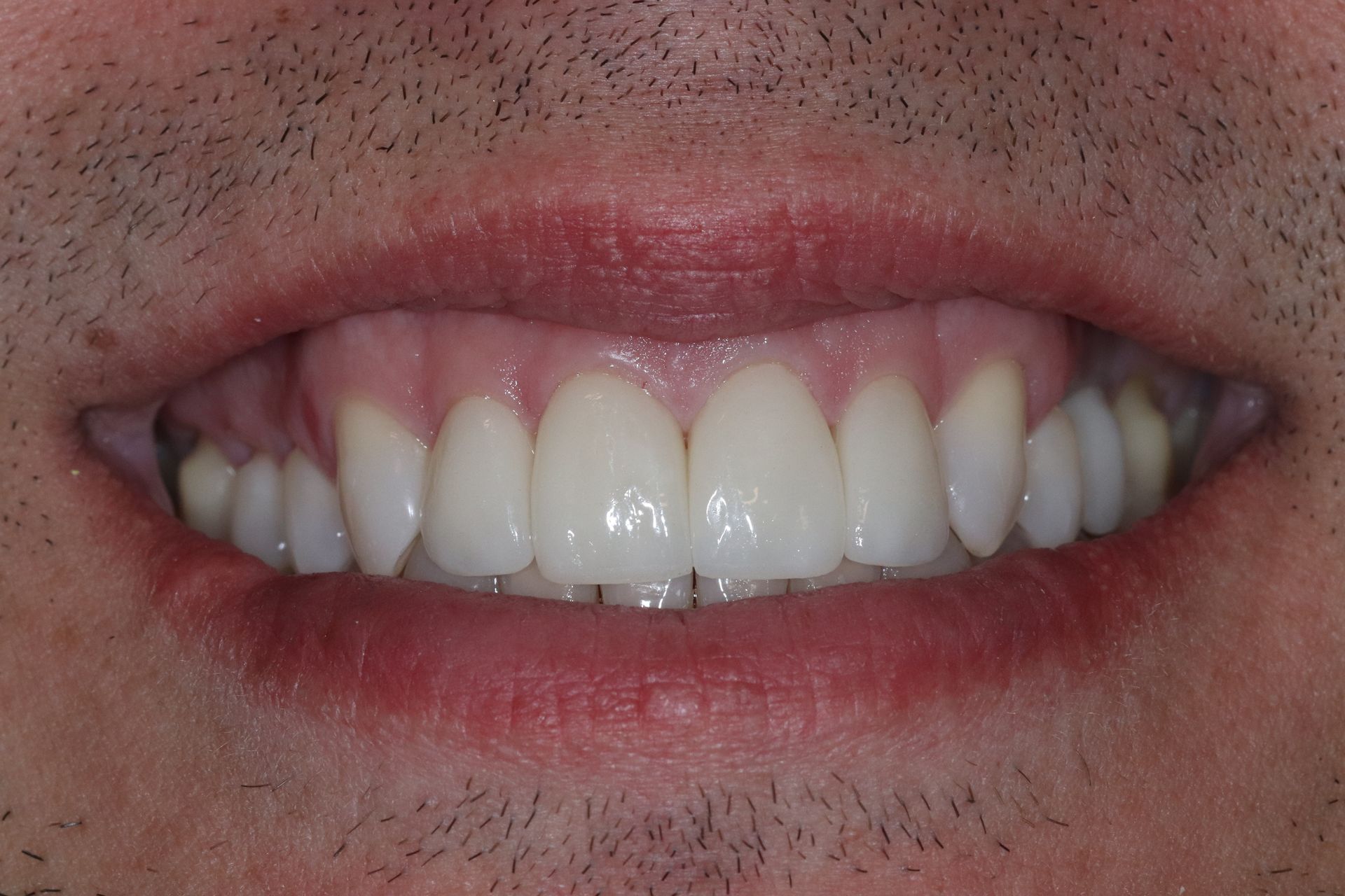 AFTER: Close-up of a smiling mouth showing white teeth and pink lips.