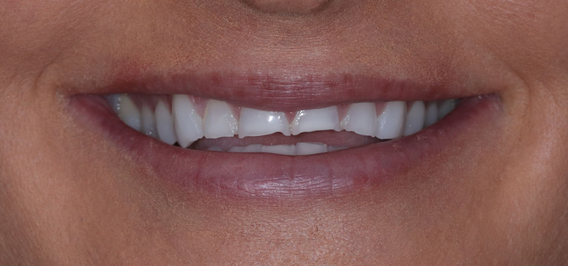 BEFORE: Close-up of a smiling mouth showing white teeth and lips