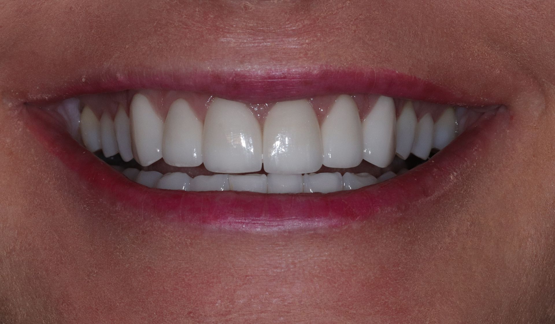 AFTER: Close-up of a smiling mouth with white teeth and pink lips.