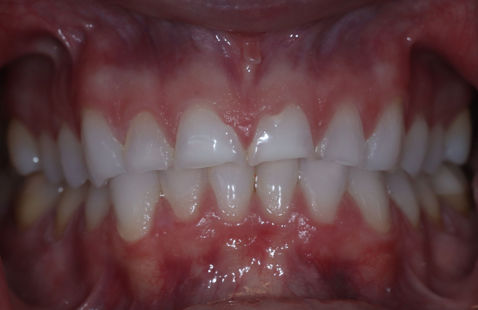 BEFORE: Close-up of teeth and gums with red, inflamed lower gums